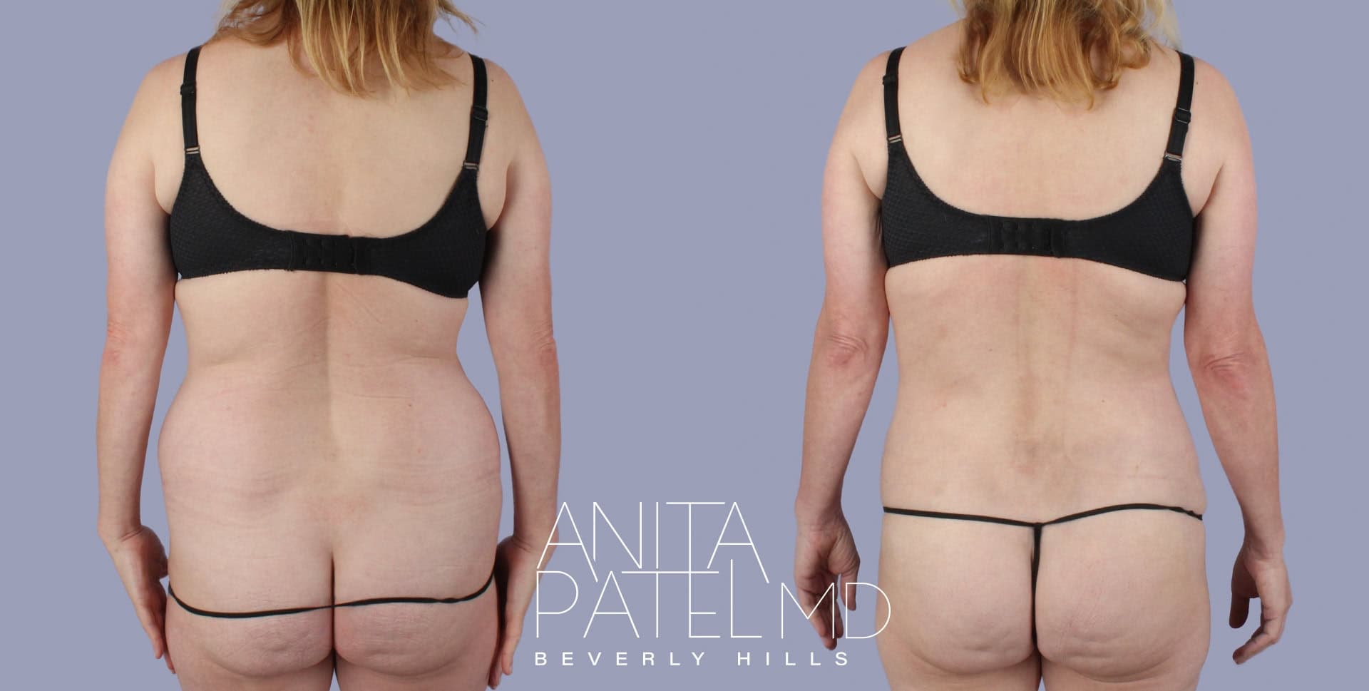 Tummy Tuck before and after — Patient 9a, photo 2 of 3 — Dr. Anita Patel, MD, FACS, Beverly Hills