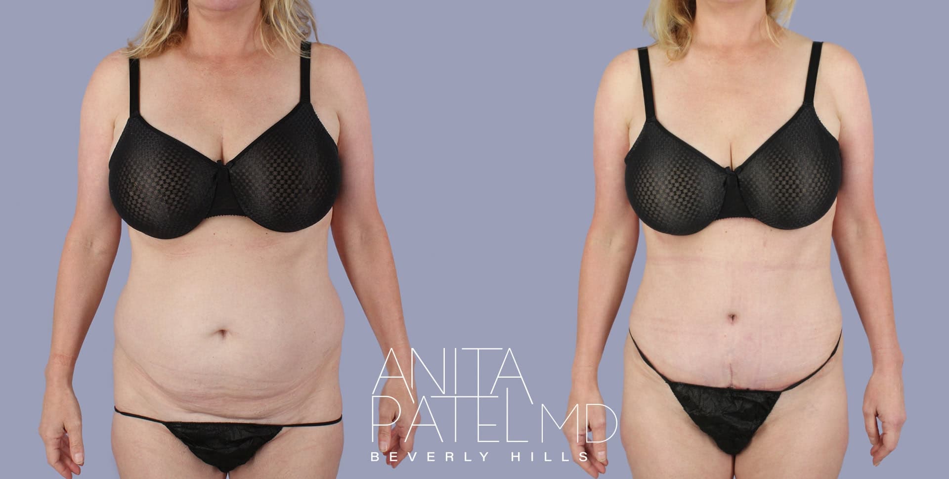 Tummy Tuck before and after — Patient 9a, photo 1 of 3 — Dr. Anita Patel, MD, FACS, Beverly Hills