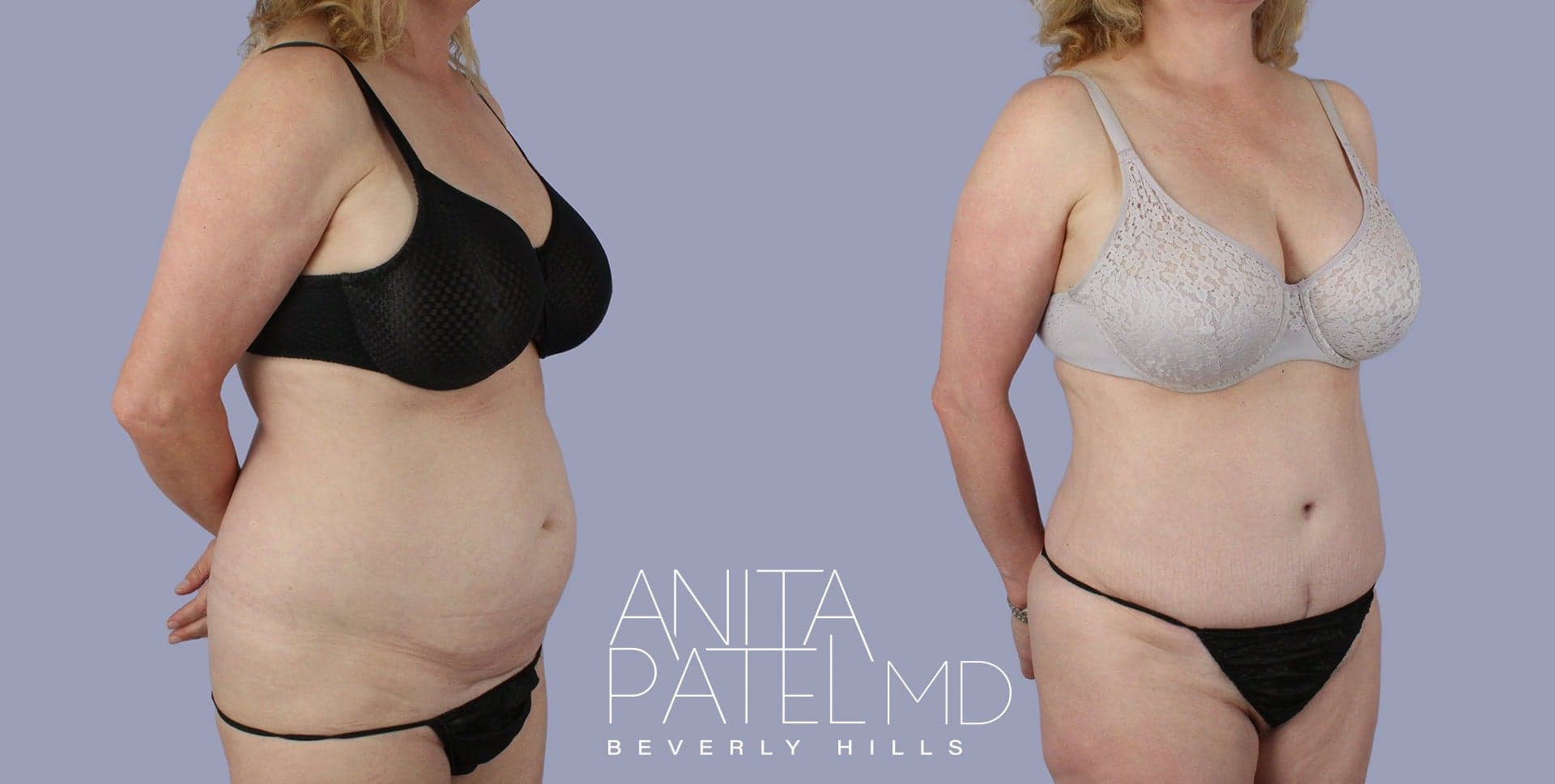 Tummy Tuck before and after — Patient 9a, photo 3 of 3 — Dr. Anita Patel, MD, FACS, Beverly Hills