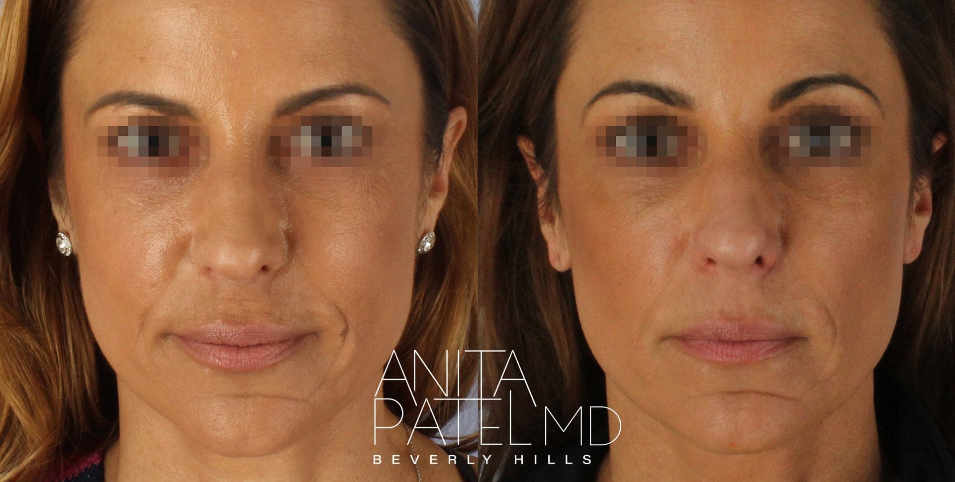 Morpheus8 RF Microneedling before and after — Patient 2, photo 1 of 2 — Dr. Anita Patel, MD, FACS, Beverly Hills