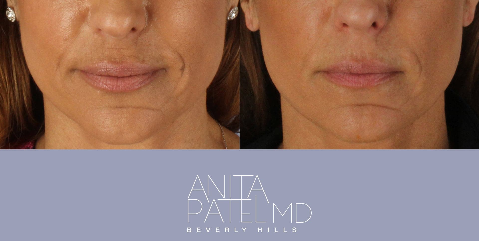 Morpheus8 RF Microneedling before and after — Patient 2, photo 2 of 2 — Dr. Anita Patel, MD, FACS, Beverly Hills