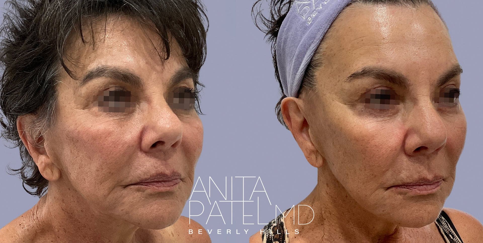 Morpheus8 RF Microneedling before and after — Patient 4 — Dr. Anita Patel, MD, FACS, Beverly Hills