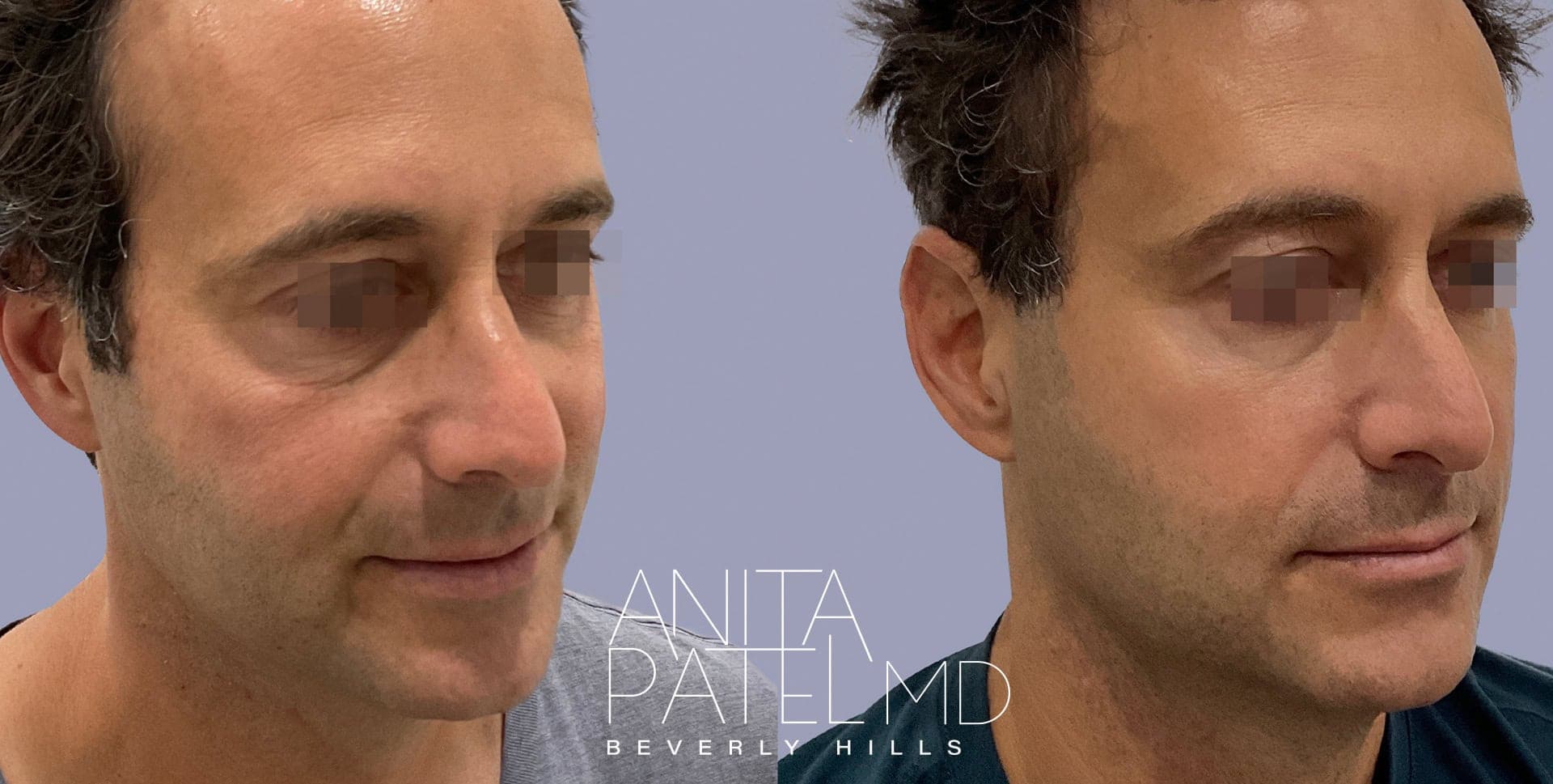 Morpheus8 RF Microneedling before and after — Patient 3, photo 1 of 2 — Dr. Anita Patel, MD, FACS, Beverly Hills