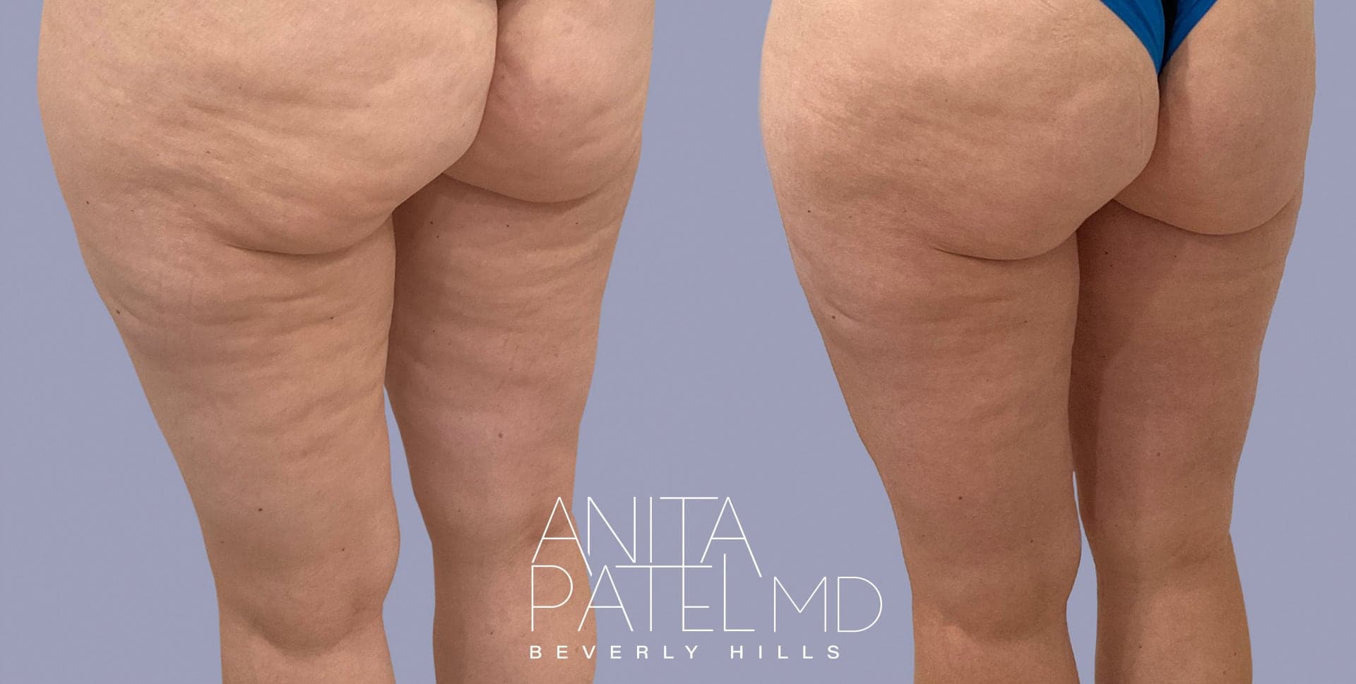 Morpheus8 RF Microneedling before and after — Patient 6 — Dr. Anita Patel, MD, FACS, Beverly Hills