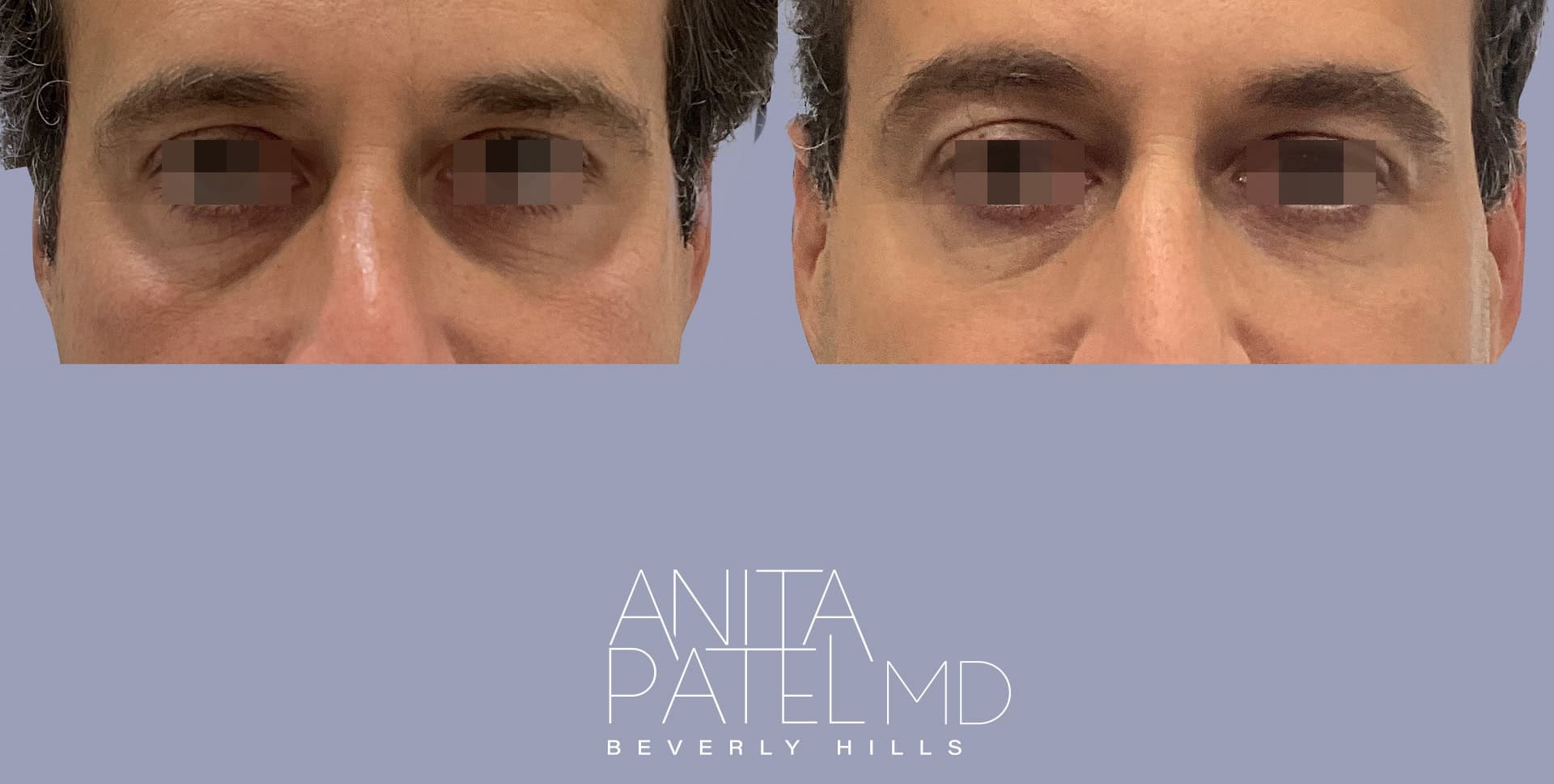 Morpheus8 RF Microneedling before and after — Patient 3, photo 2 of 2 — Dr. Anita Patel, MD, FACS, Beverly Hills