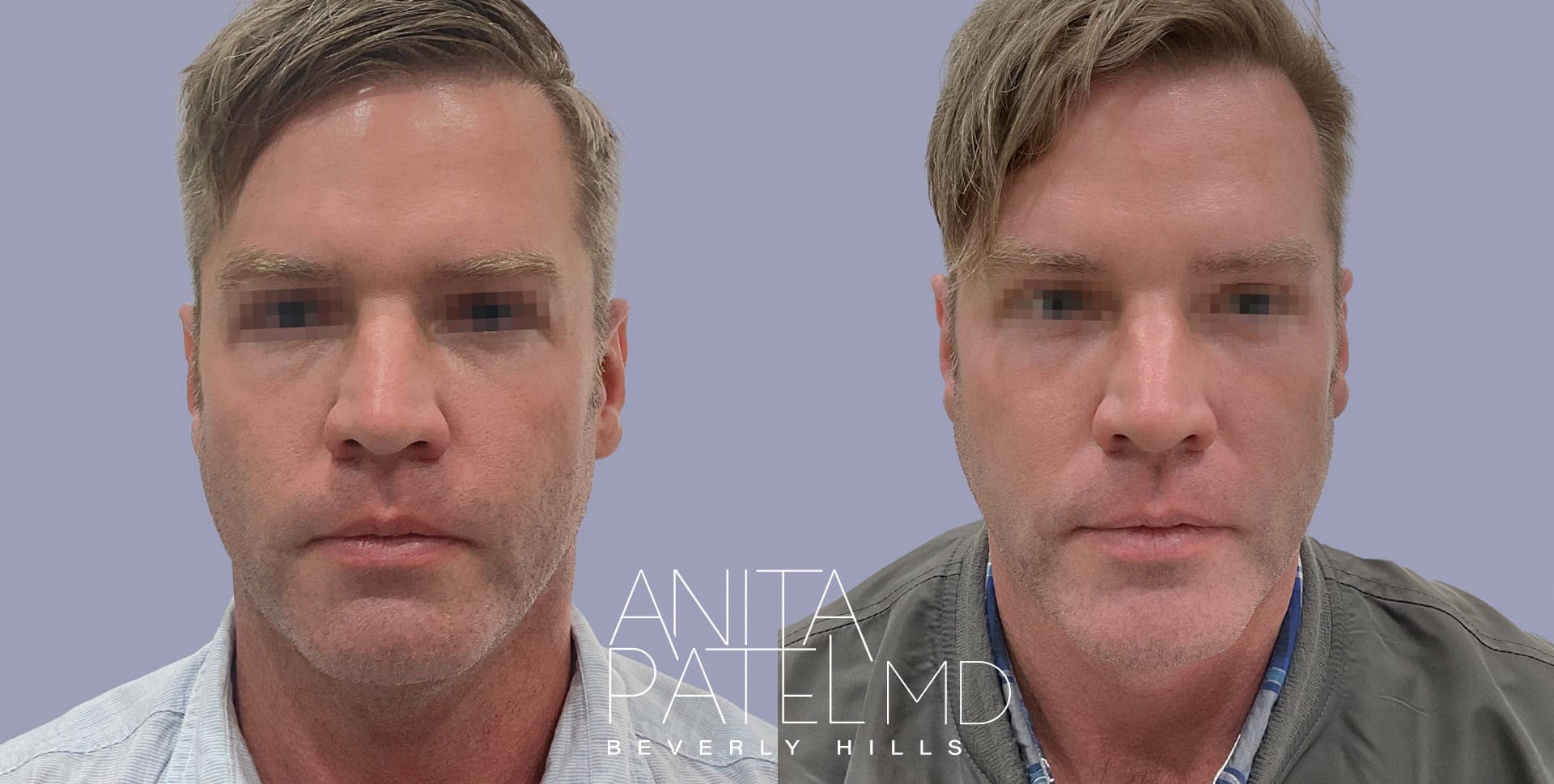 Morpheus8 RF Microneedling before and after — Patient 7 — Dr. Anita Patel, MD, FACS, Beverly Hills