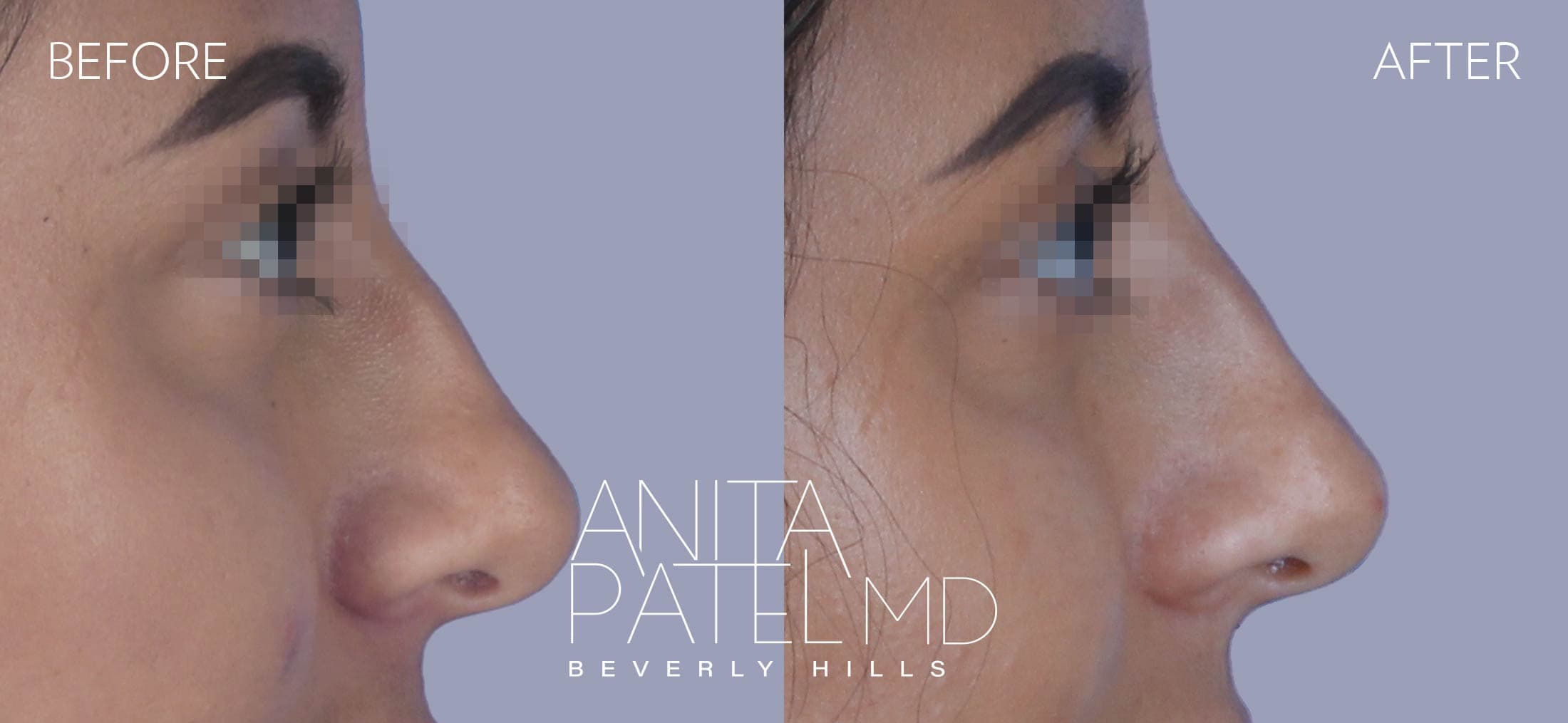 Liquid Rhinoplasty before and after — Patient 10, photo 1 of 2 — Dr. Anita Patel, MD, FACS, Beverly Hills