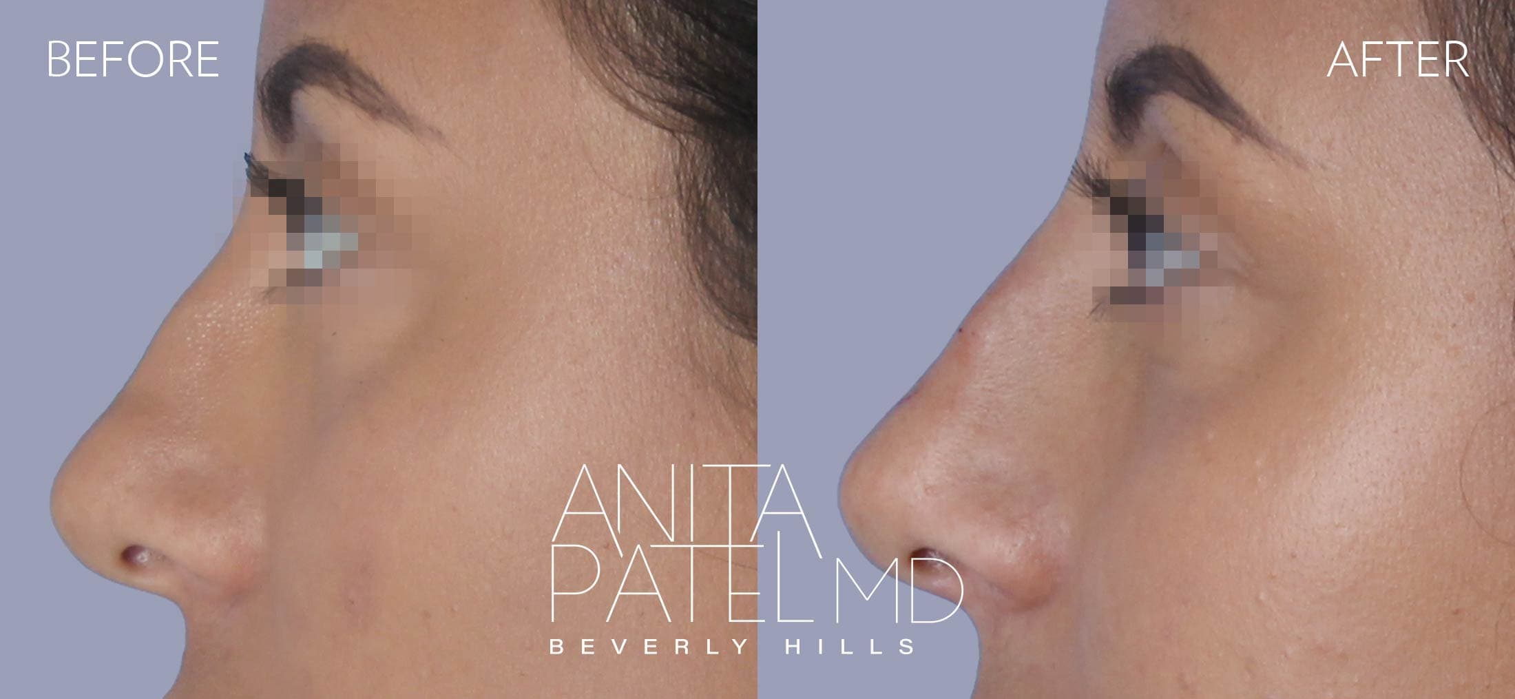 Liquid Rhinoplasty before and after — Patient 10, photo 2 of 2 — Dr. Anita Patel, MD, FACS, Beverly Hills