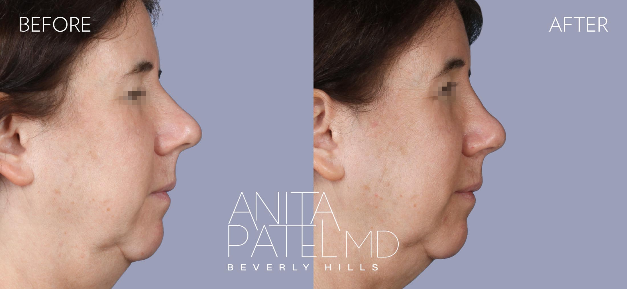 Rhinoplasty before and after — Patient 10 — Dr. Anita Patel, MD, FACS, Beverly Hills