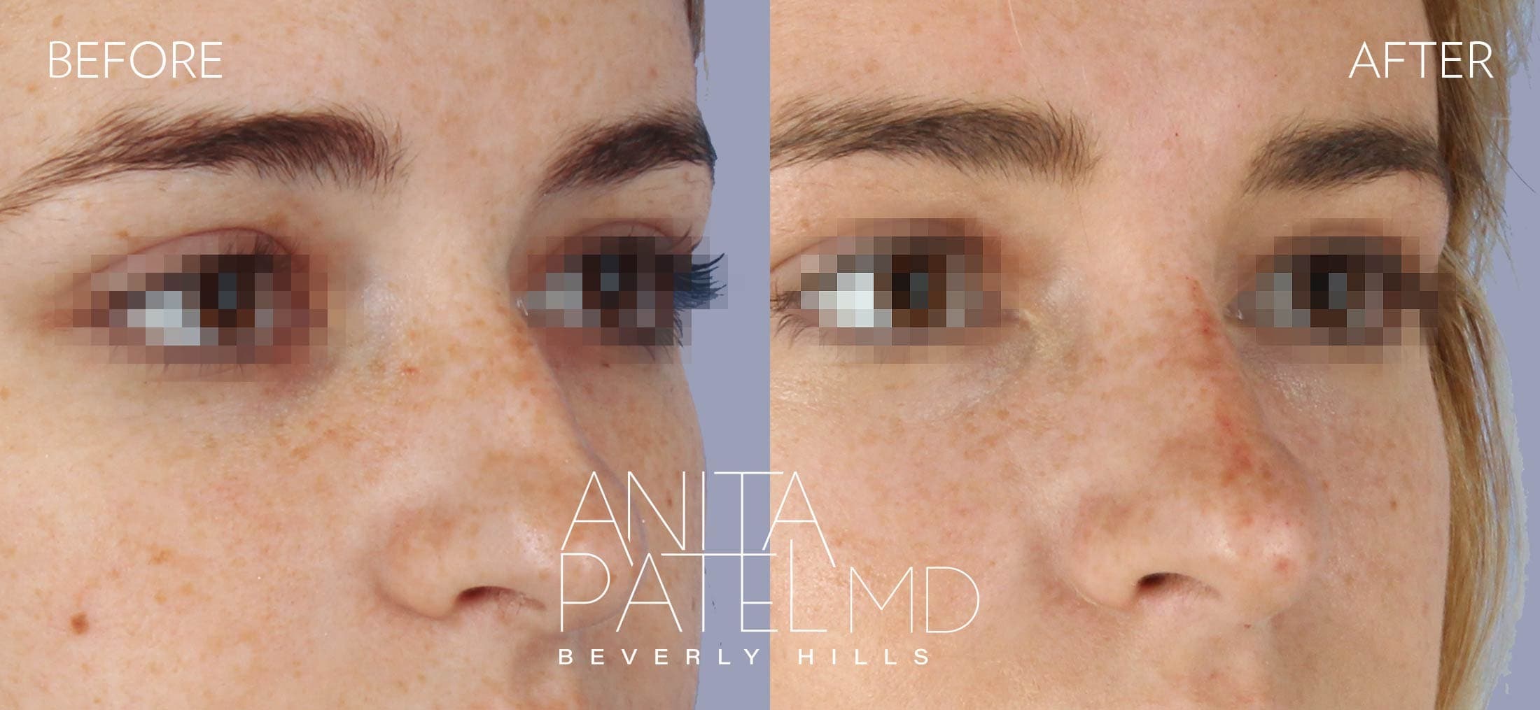 Liquid Rhinoplasty before and after — Patient 11, photo 1 of 4 — Dr. Anita Patel, MD, FACS, Beverly Hills