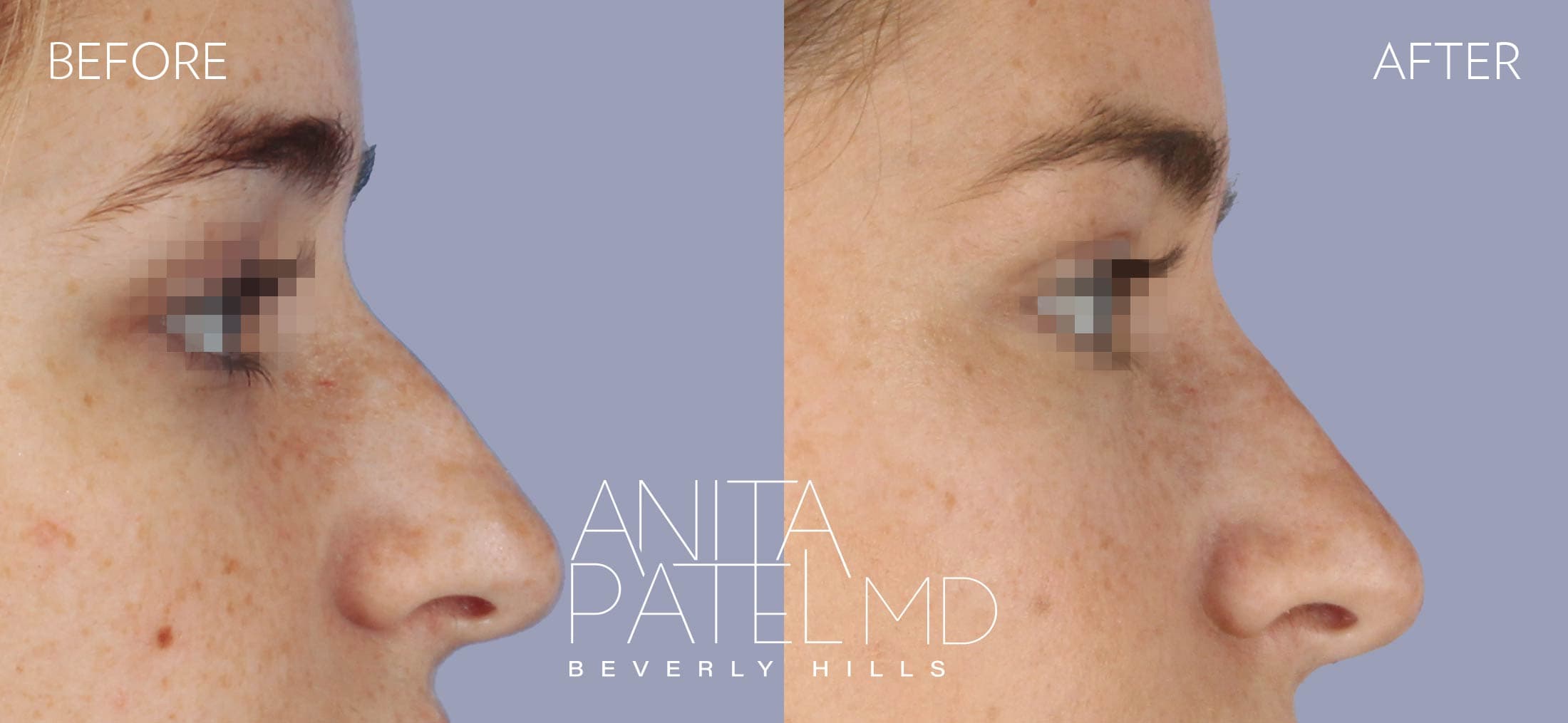 Liquid Rhinoplasty before and after — Patient 11, photo 2 of 4 — Dr. Anita Patel, MD, FACS, Beverly Hills