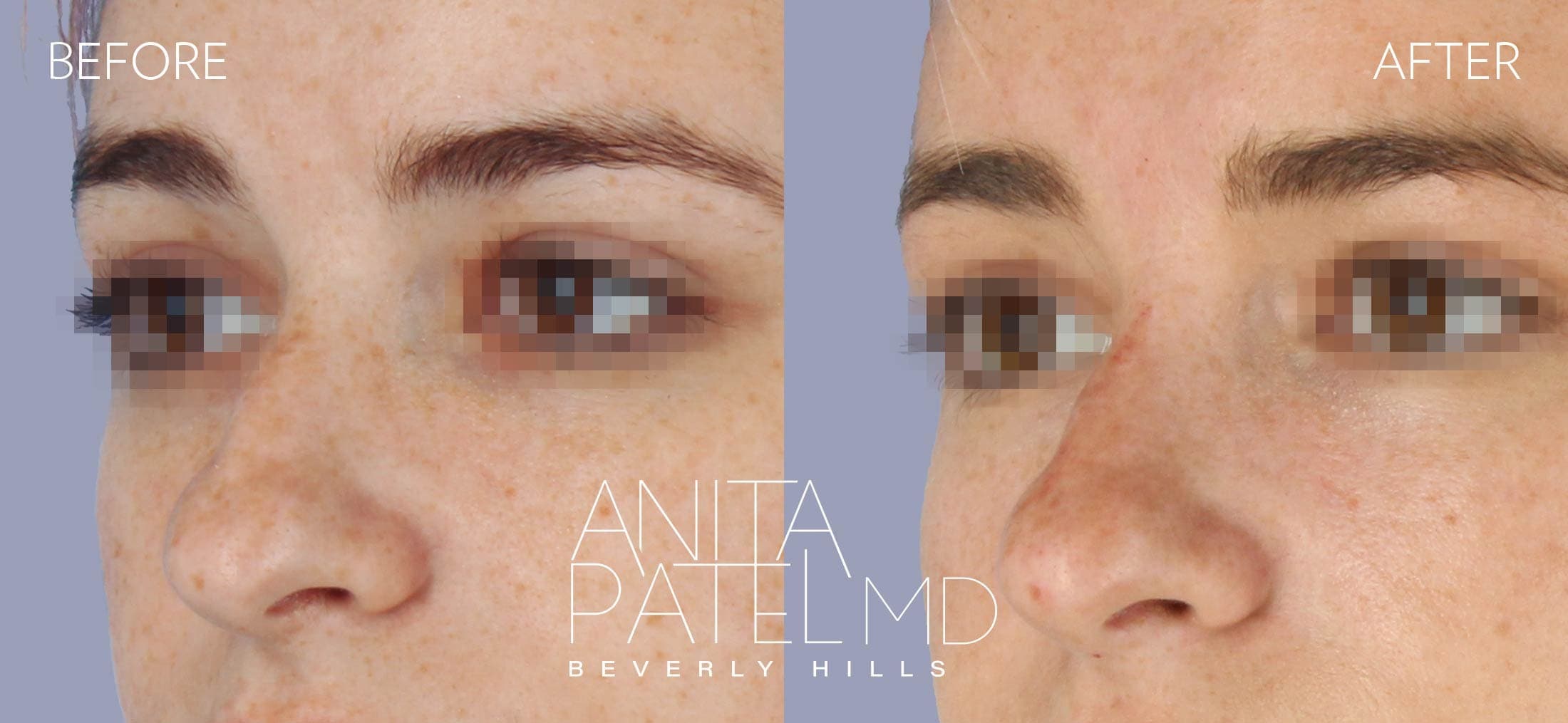 Liquid Rhinoplasty before and after — Patient 11, photo 3 of 4 — Dr. Anita Patel, MD, FACS, Beverly Hills
