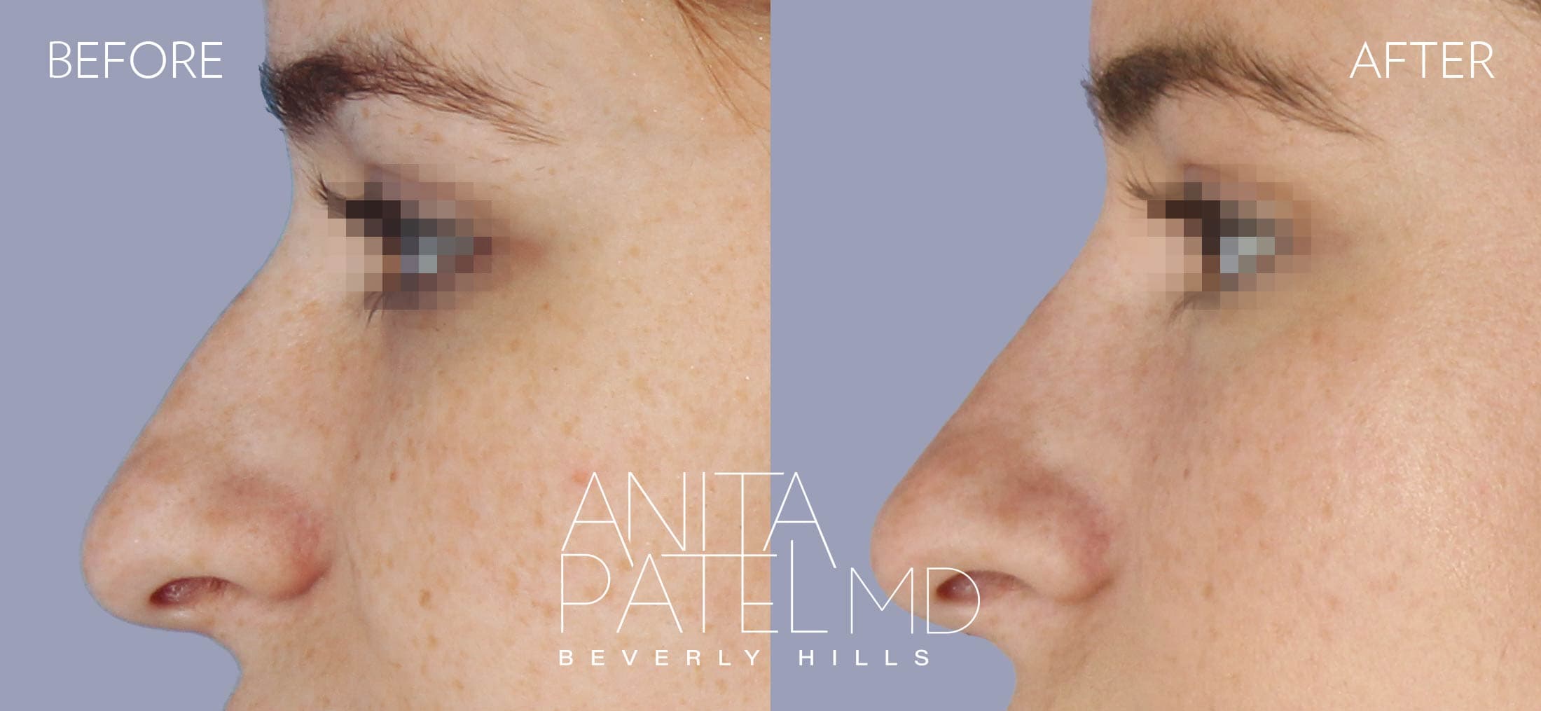 Liquid Rhinoplasty before and after — Patient 11, photo 4 of 4 — Dr. Anita Patel, MD, FACS, Beverly Hills