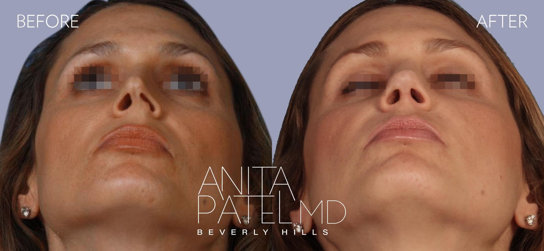 Rhinoplasty before and after — Patient 9 — Dr. Anita Patel, MD, FACS, Beverly Hills