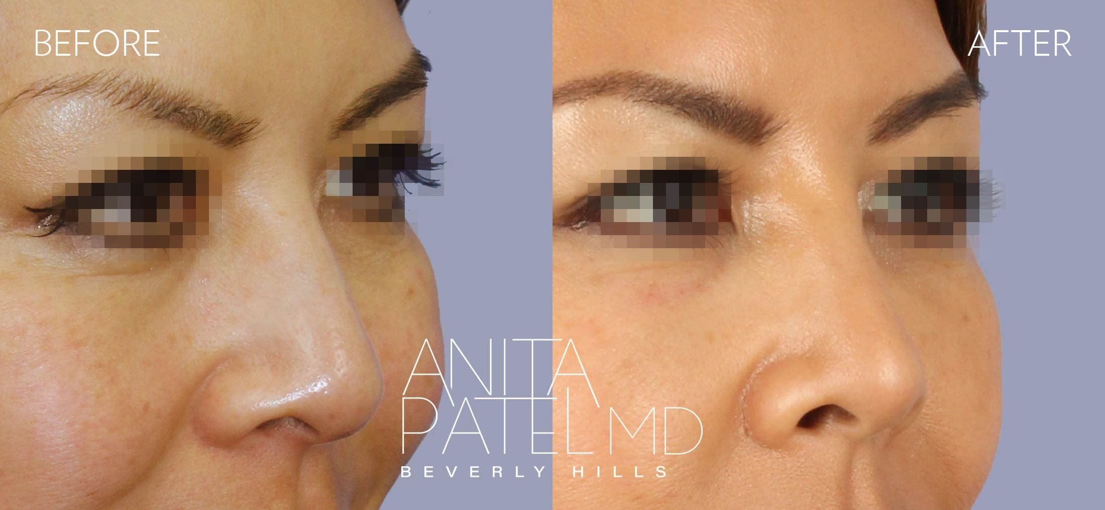 Liquid Rhinoplasty before and after — Patient 16, photo 1 of 4 — Dr. Anita Patel, MD, FACS, Beverly Hills