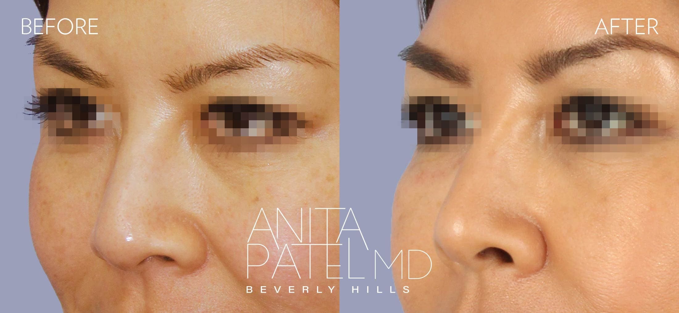 Liquid Rhinoplasty before and after — Patient 12, photo 2 of 4 — Dr. Anita Patel, MD, FACS, Beverly Hills