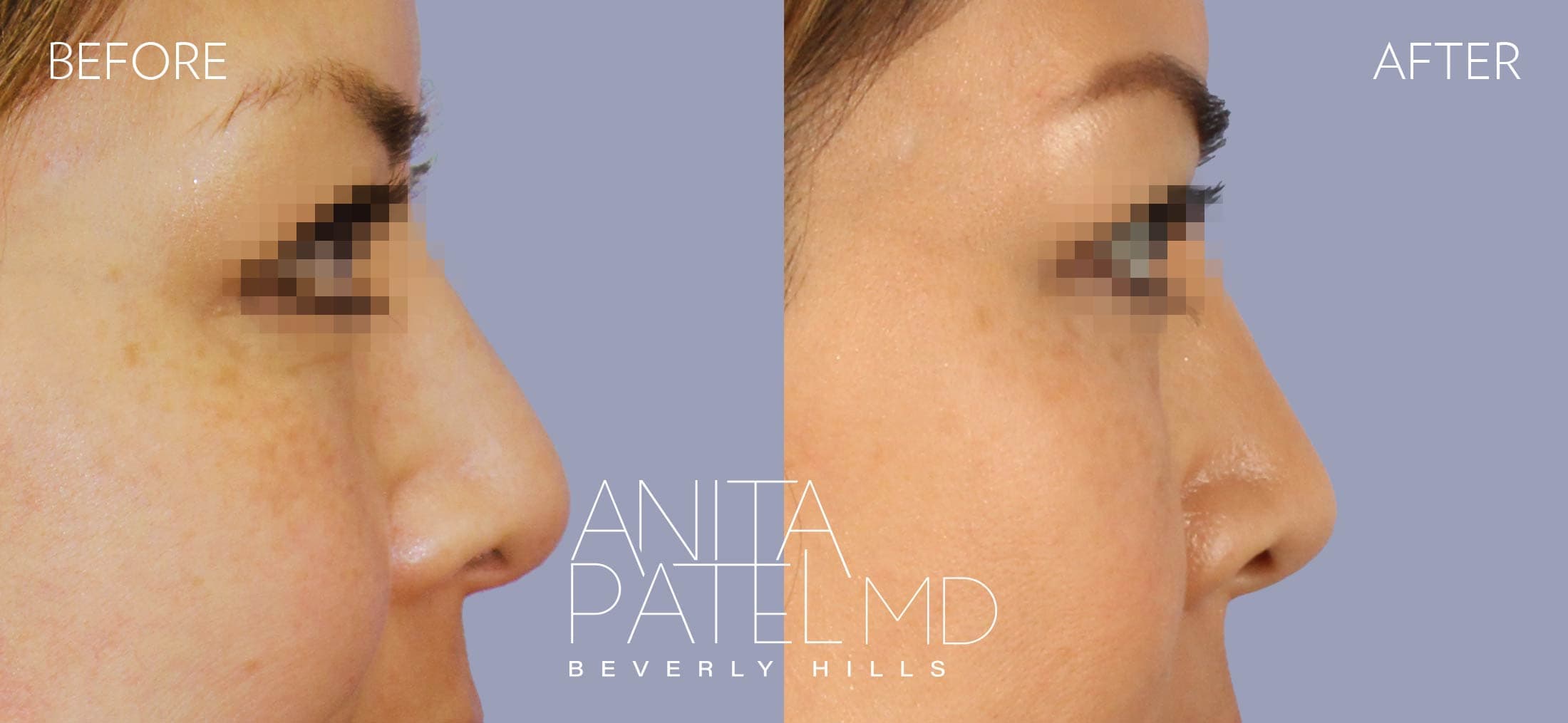 Liquid Rhinoplasty before and after — Patient 16, photo 3 of 4 — Dr. Anita Patel, MD, FACS, Beverly Hills