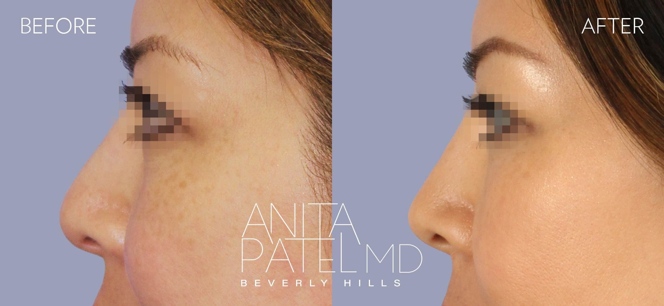 Liquid Rhinoplasty before and after — Patient 12, photo 4 of 4 — Dr. Anita Patel, MD, FACS, Beverly Hills