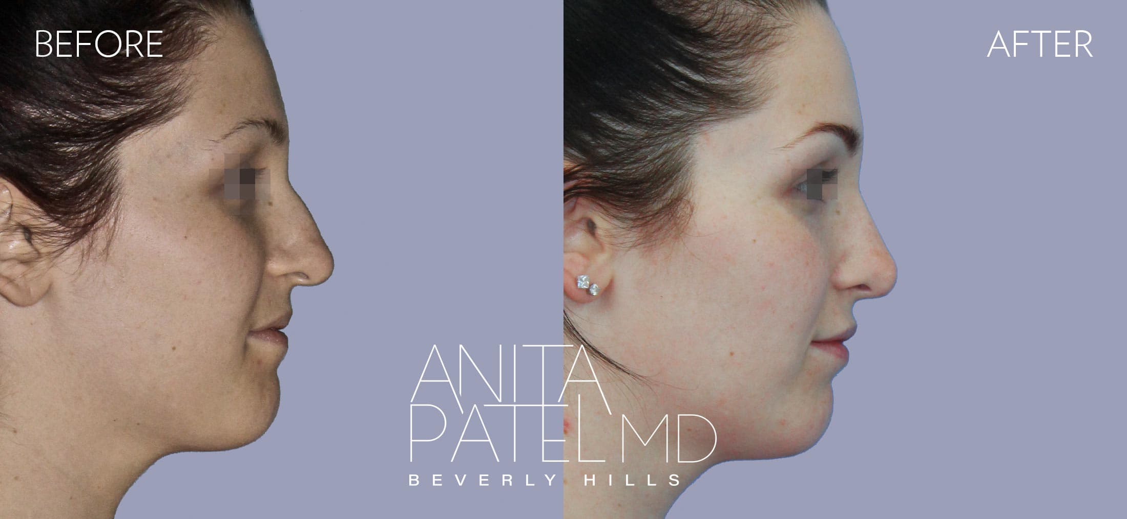 Rhinoplasty before and after — Patient 2 — Dr. Anita Patel, MD, FACS, Beverly Hills