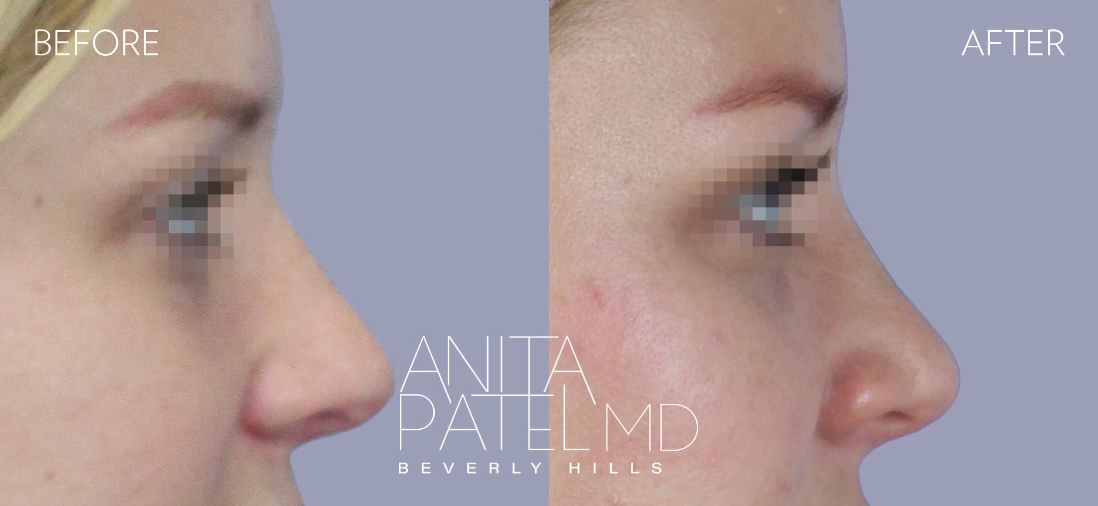 Liquid Rhinoplasty before and after — Patient 14, photo 1 of 2 — Dr. Anita Patel, MD, FACS, Beverly Hills