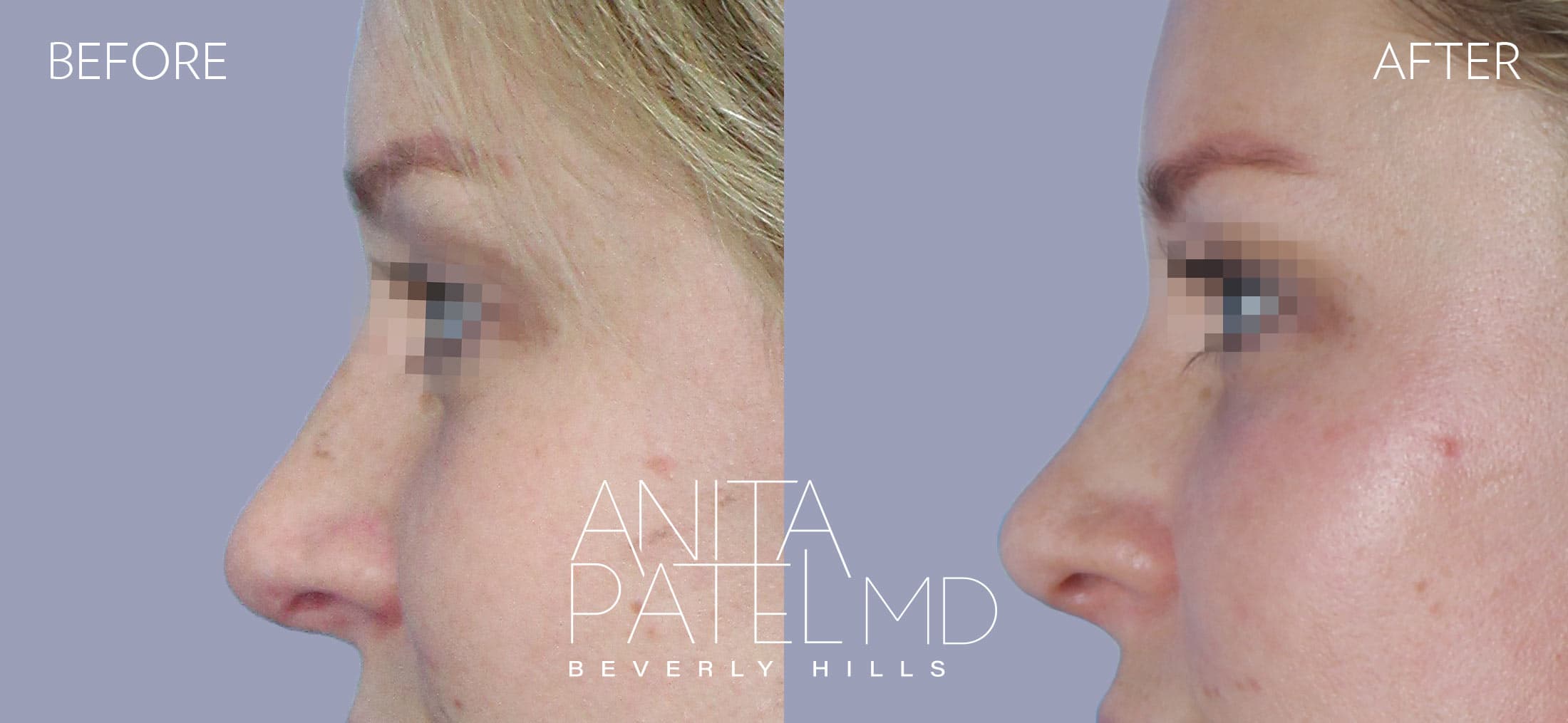 Liquid Rhinoplasty before and after — Patient 14, photo 2 of 2 — Dr. Anita Patel, MD, FACS, Beverly Hills