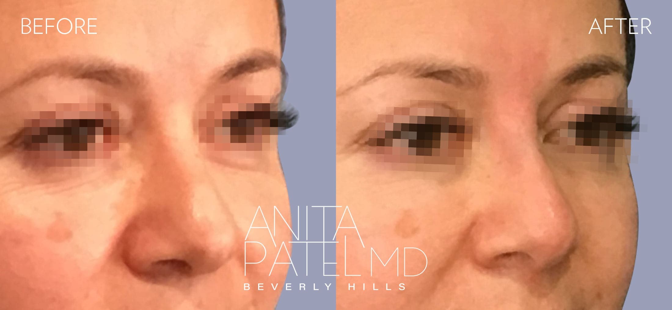 Liquid Rhinoplasty before and after — Patient 15, photo 1 of 4 — Dr. Anita Patel, MD, FACS, Beverly Hills