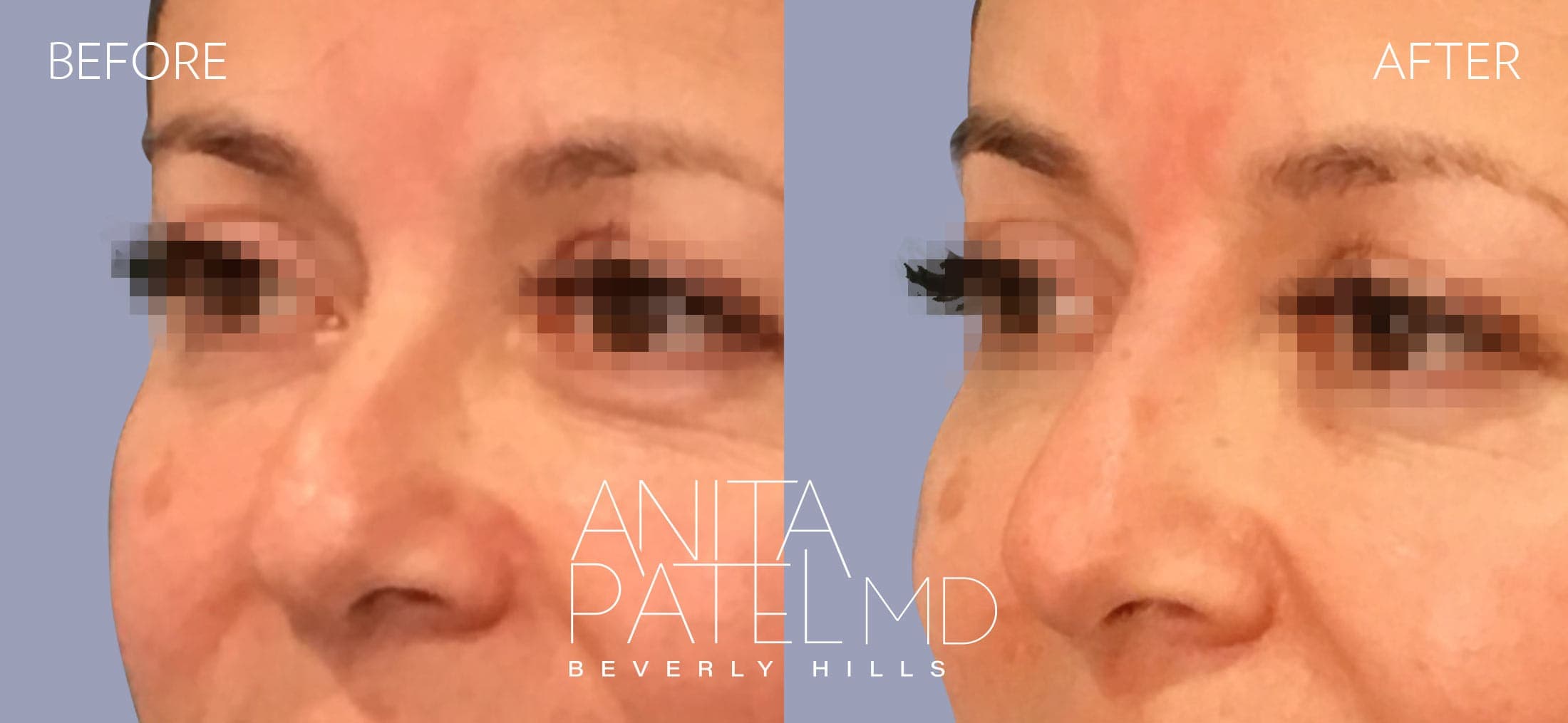 Liquid Rhinoplasty before and after — Patient 15, photo 2 of 4 — Dr. Anita Patel, MD, FACS, Beverly Hills