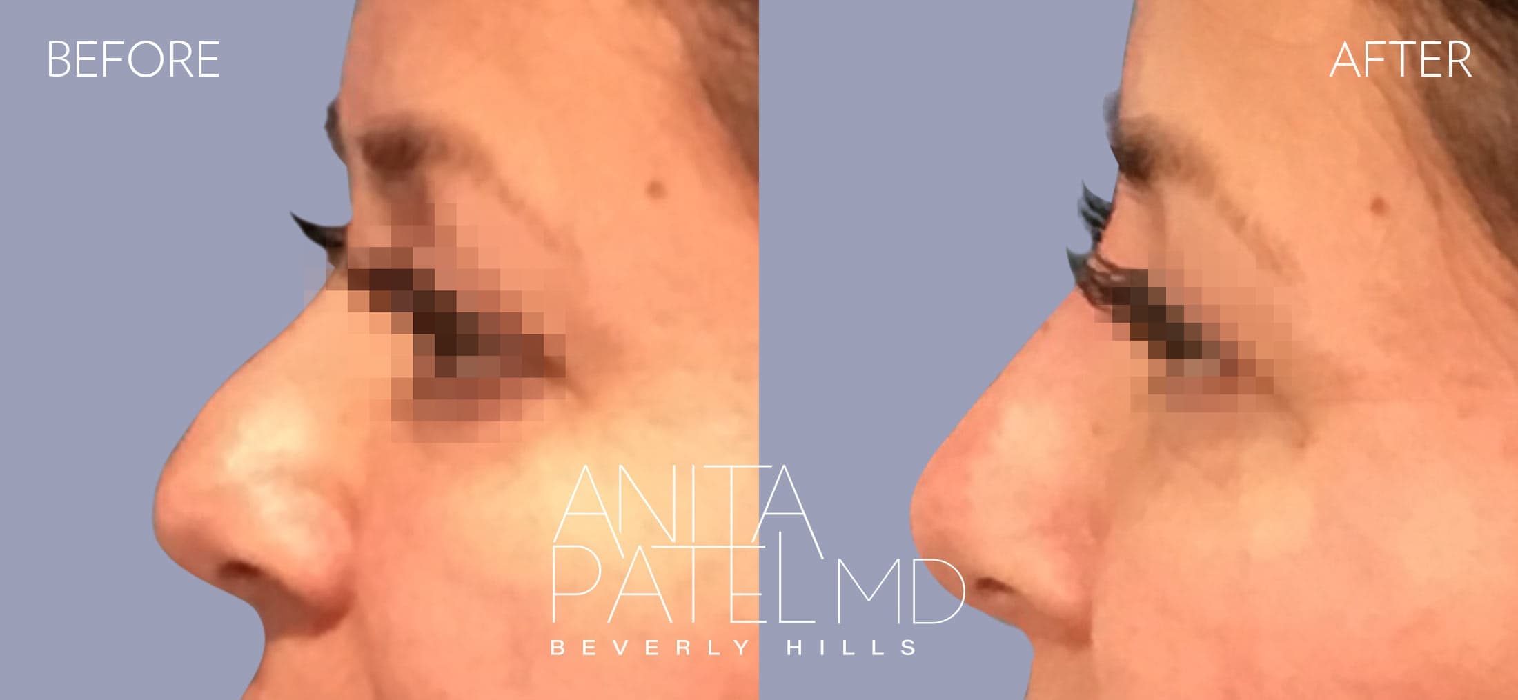 Liquid Rhinoplasty before and after — Patient 15, photo 3 of 4 — Dr. Anita Patel, MD, FACS, Beverly Hills
