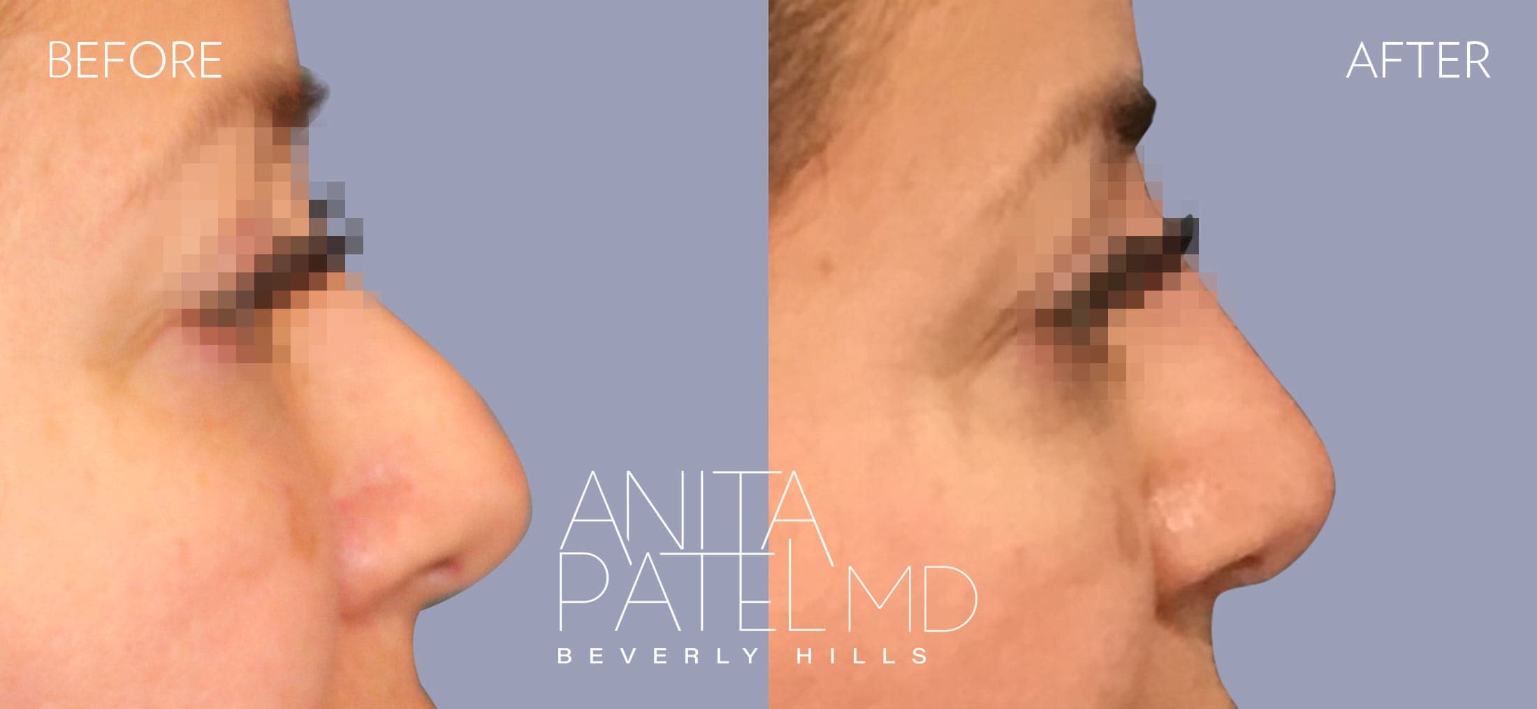 Liquid Rhinoplasty before and after — Patient 15, photo 4 of 4 — Dr. Anita Patel, MD, FACS, Beverly Hills