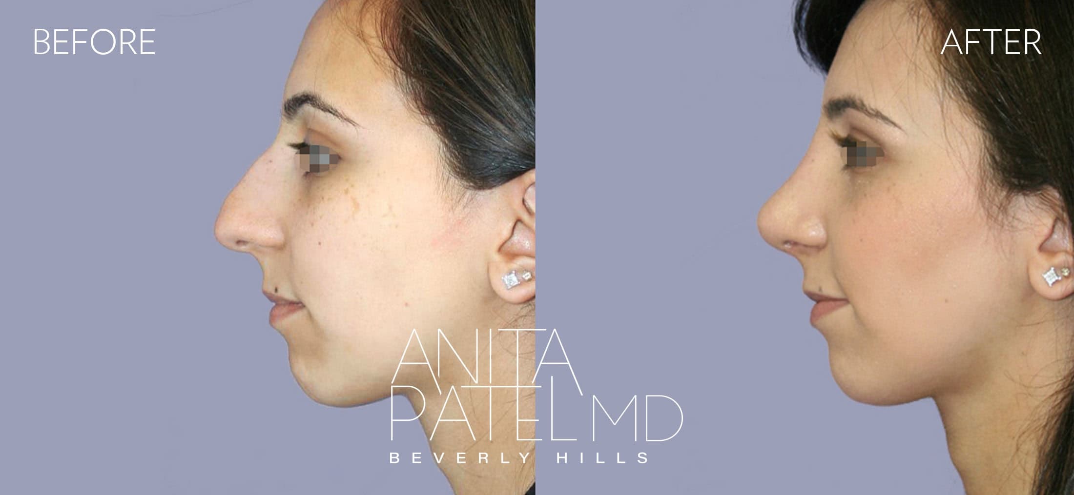 Rhinoplasty before and after — Patient 3 — Dr. Anita Patel, MD, FACS, Beverly Hills