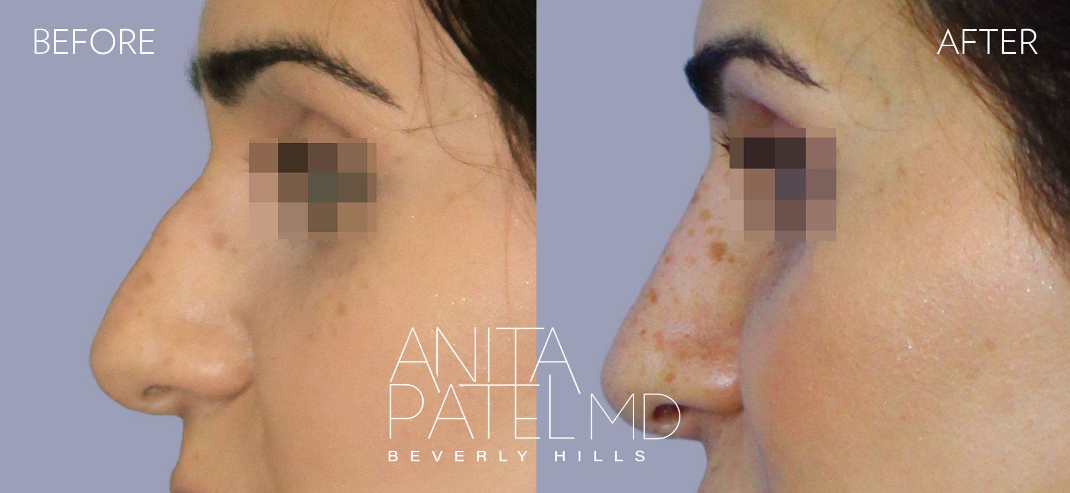 Rhinoplasty before and after — Patient 15, photo 2 of 2 — Dr. Anita Patel, MD, FACS, Beverly Hills