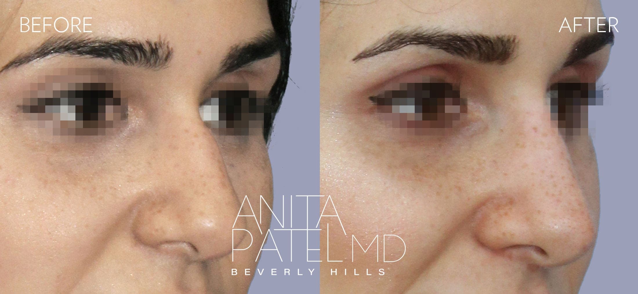 Liquid Rhinoplasty before and after — Patient 2, photo 3 of 4 — Dr. Anita Patel, MD, FACS, Beverly Hills