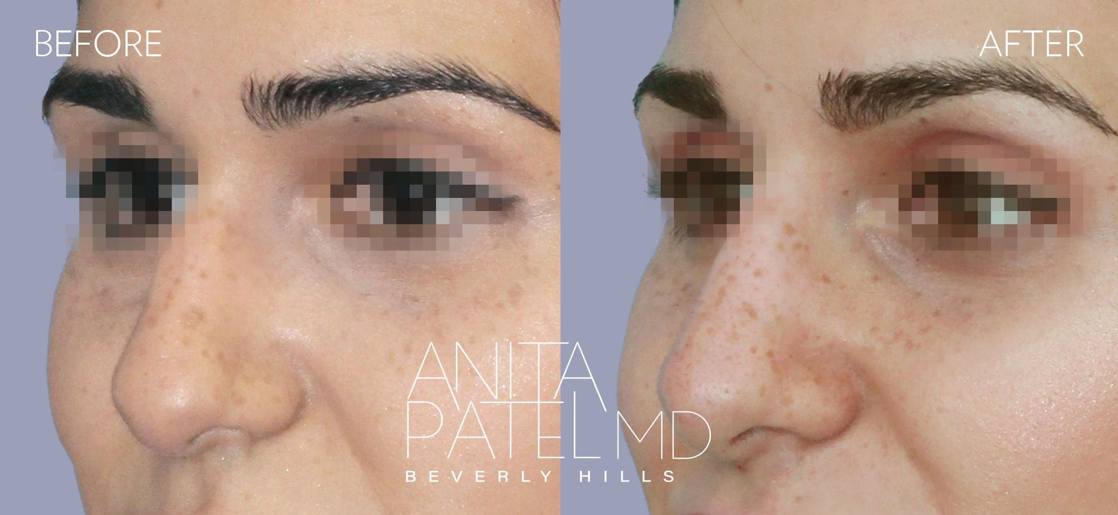 Liquid Rhinoplasty before and after — Patient 2, photo 4 of 4 — Dr. Anita Patel, MD, FACS, Beverly Hills