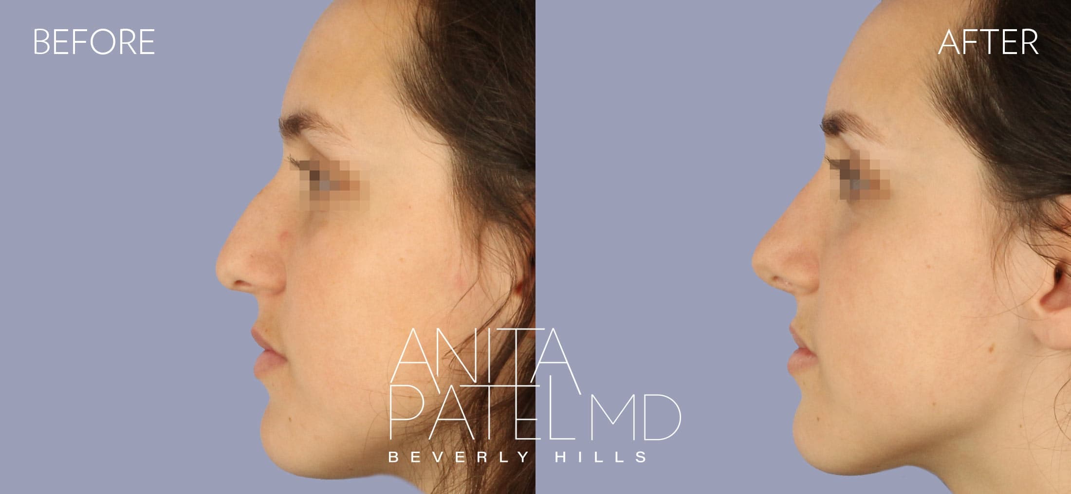 Rhinoplasty before and after — Dr. Anita Patel, Beverly Hills
