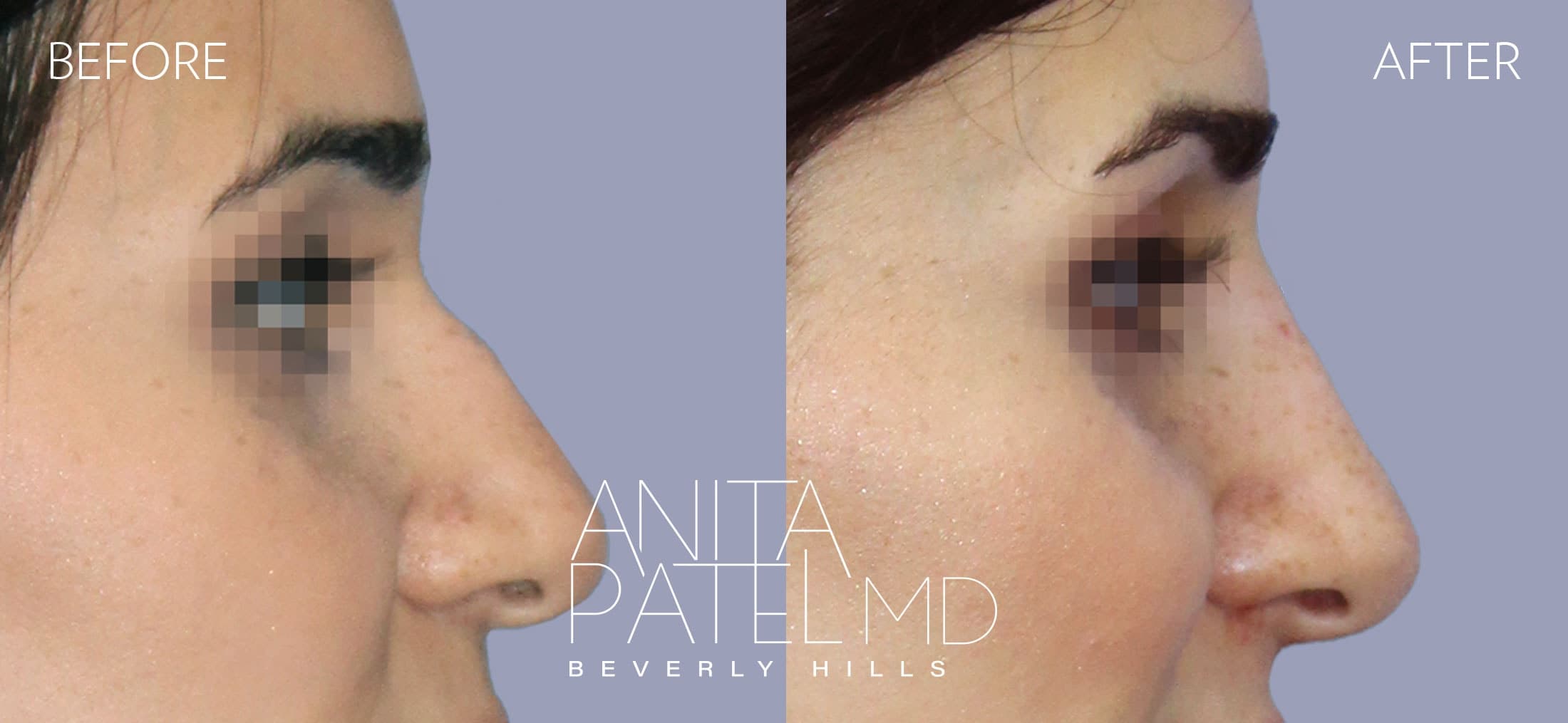 Liquid Rhinoplasty before and after — Patient 2, photo 1 of 4 — Dr. Anita Patel, MD, FACS, Beverly Hills