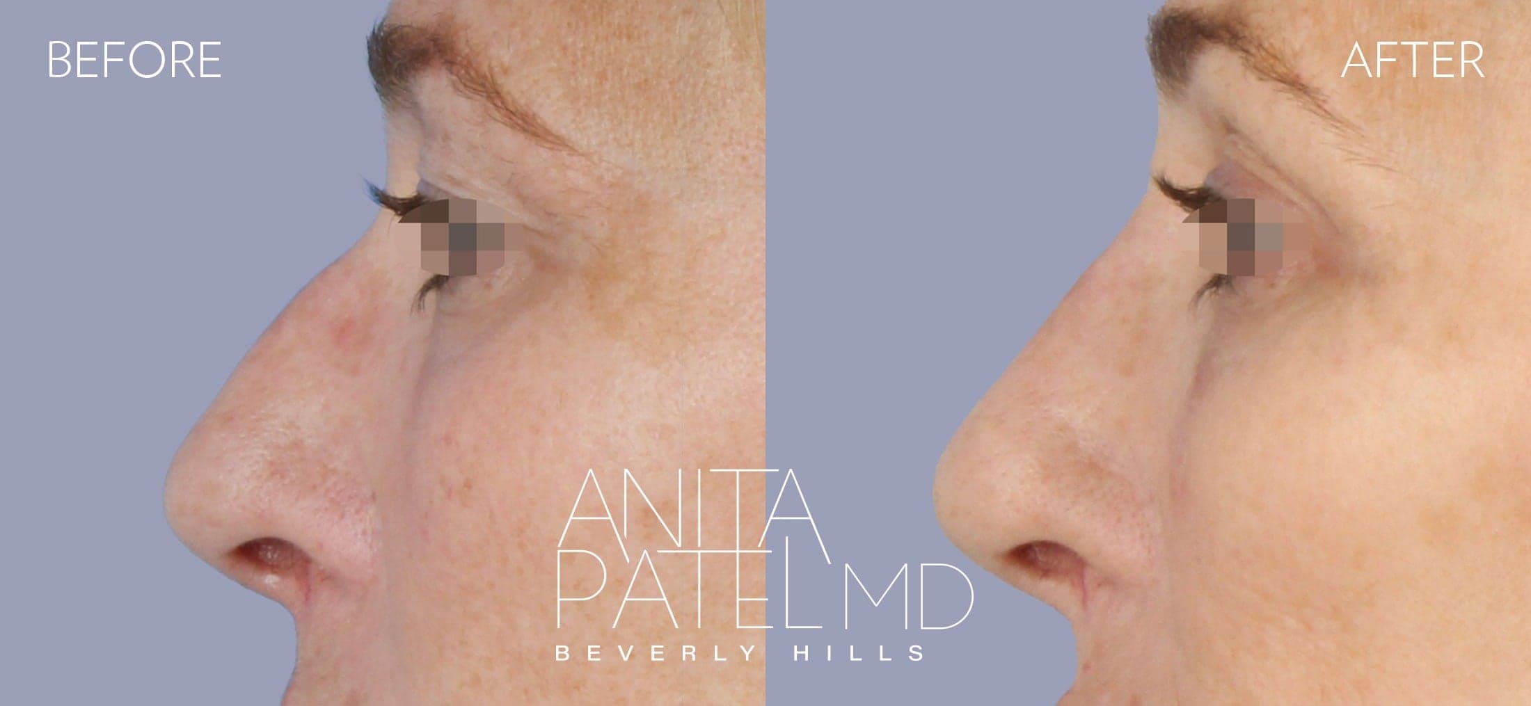 Liquid Rhinoplasty before and after — Patient 3, photo 2 of 2 — Dr. Anita Patel, MD, FACS, Beverly Hills