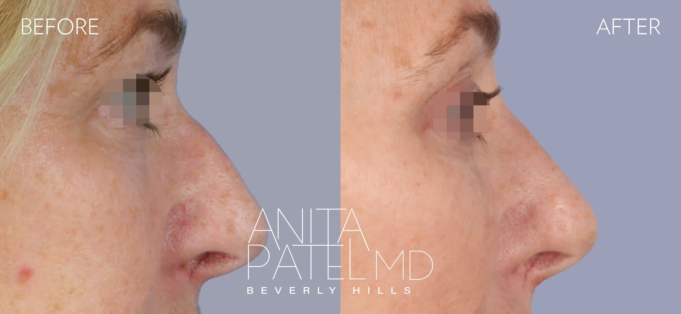 Liquid Rhinoplasty before and after — Patient 3, photo 1 of 2 — Dr. Anita Patel, MD, FACS, Beverly Hills