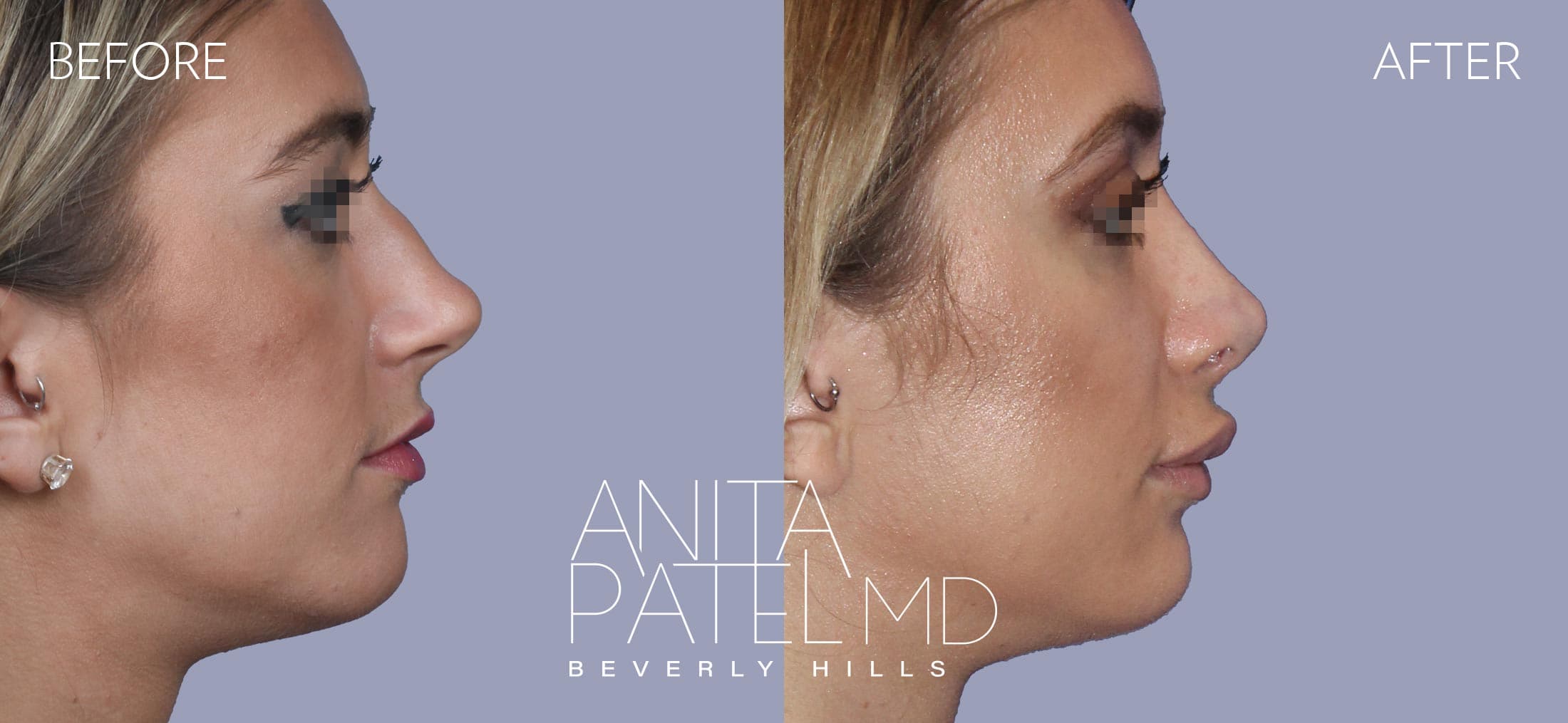 Rhinoplasty before and after — Patient 16 — Dr. Anita Patel, MD, FACS, Beverly Hills