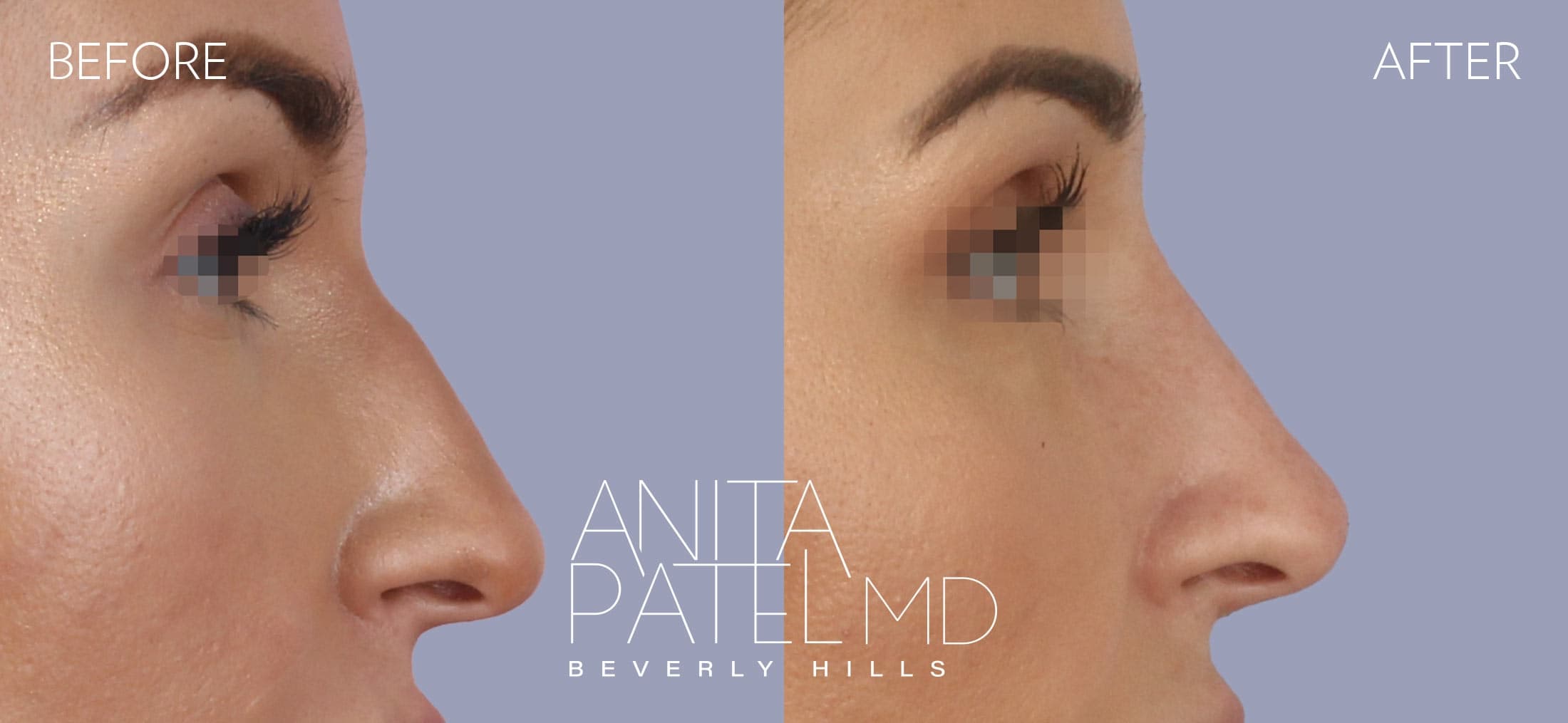 Rhinoplasty before and after — Patient 14 — Dr. Anita Patel, MD, FACS, Beverly Hills