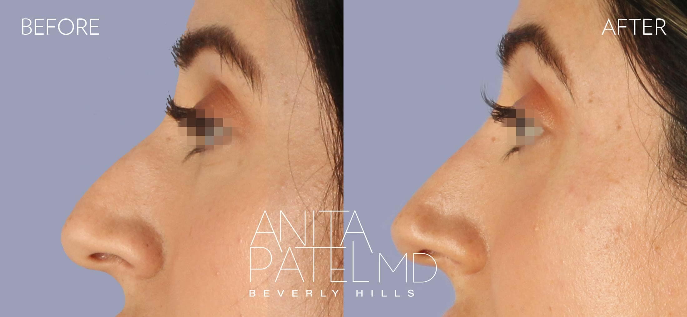 Rhinoplasty before and after — Patient 11, photo 1 of 2 — Dr. Anita Patel, MD, FACS, Beverly Hills