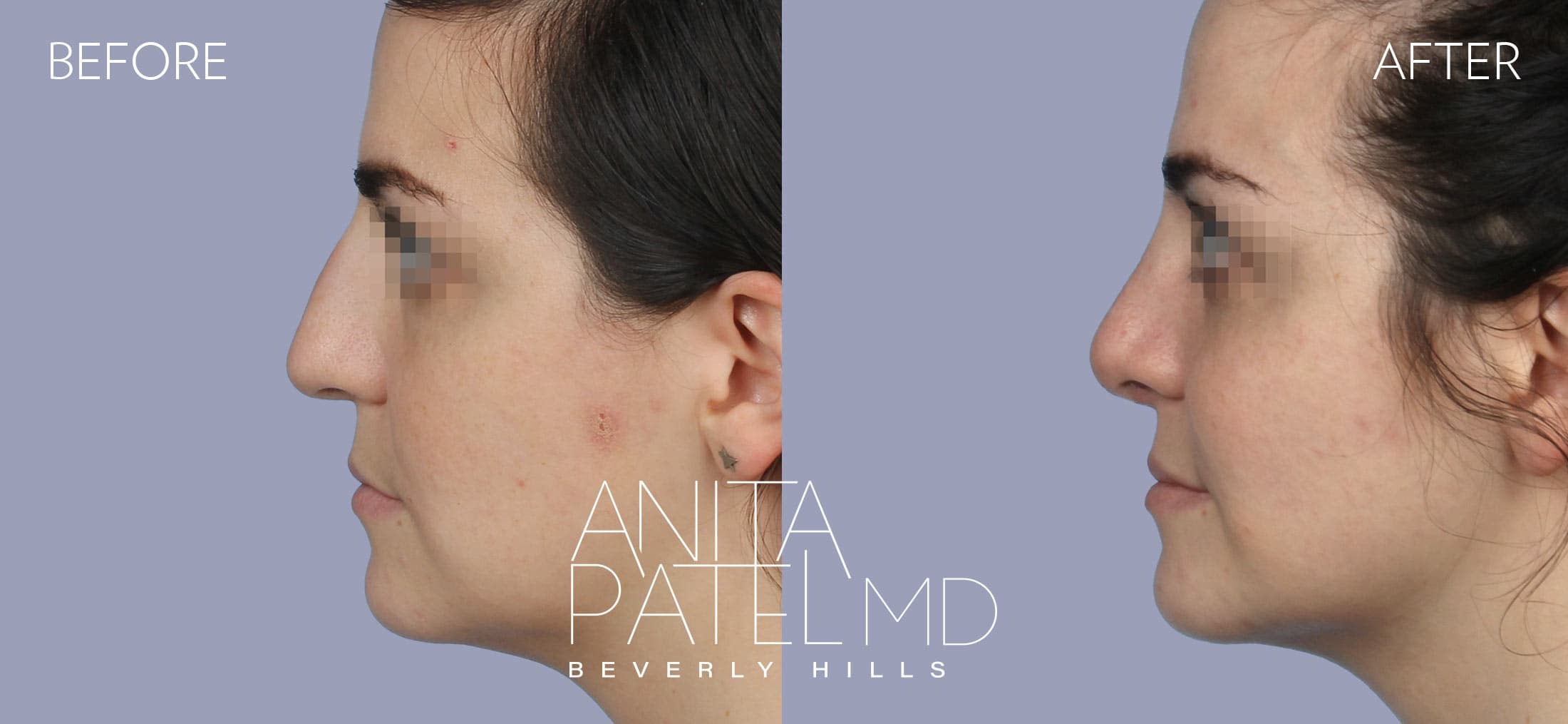 Rhinoplasty before and after — Patient 5 — Dr. Anita Patel, MD, FACS, Beverly Hills