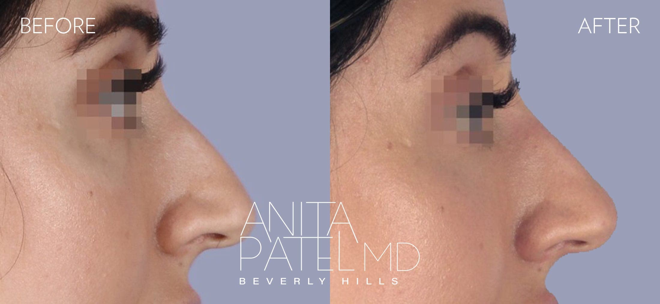 Liquid Rhinoplasty before and after — Patient 5, photo 1 of 2 — Dr. Anita Patel, MD, FACS, Beverly Hills