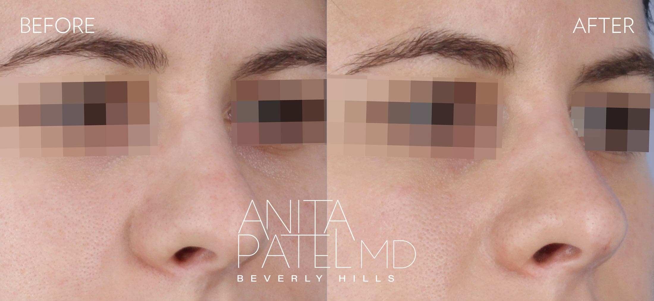 Liquid Rhinoplasty before and after — Patient 6, photo 1 of 4 — Dr. Anita Patel, MD, FACS, Beverly Hills