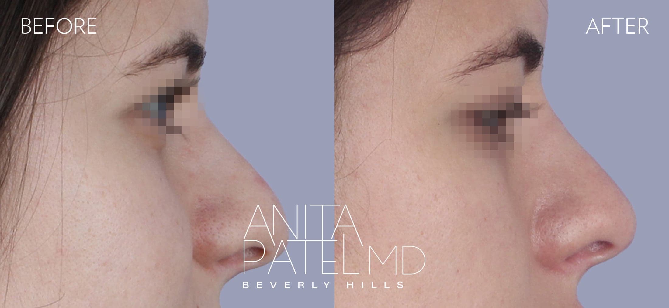 Liquid Rhinoplasty before and after — Patient 6, photo 2 of 4 — Dr. Anita Patel, MD, FACS, Beverly Hills
