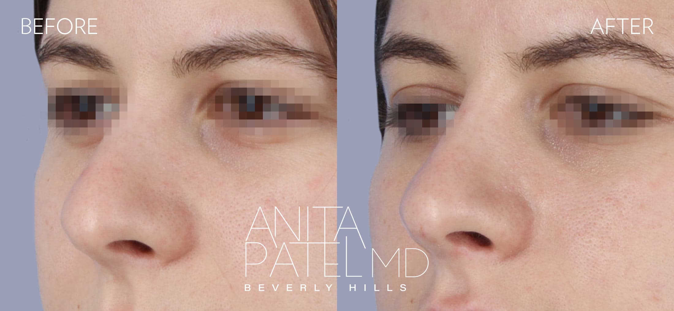 Liquid Rhinoplasty before and after — Patient 6, photo 3 of 4 — Dr. Anita Patel, MD, FACS, Beverly Hills