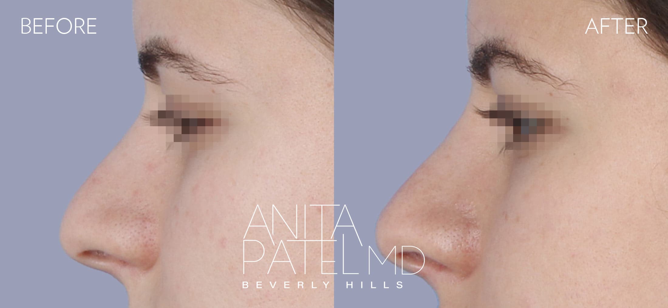 Liquid Rhinoplasty before and after — Patient 6, photo 4 of 4 — Dr. Anita Patel, MD, FACS, Beverly Hills