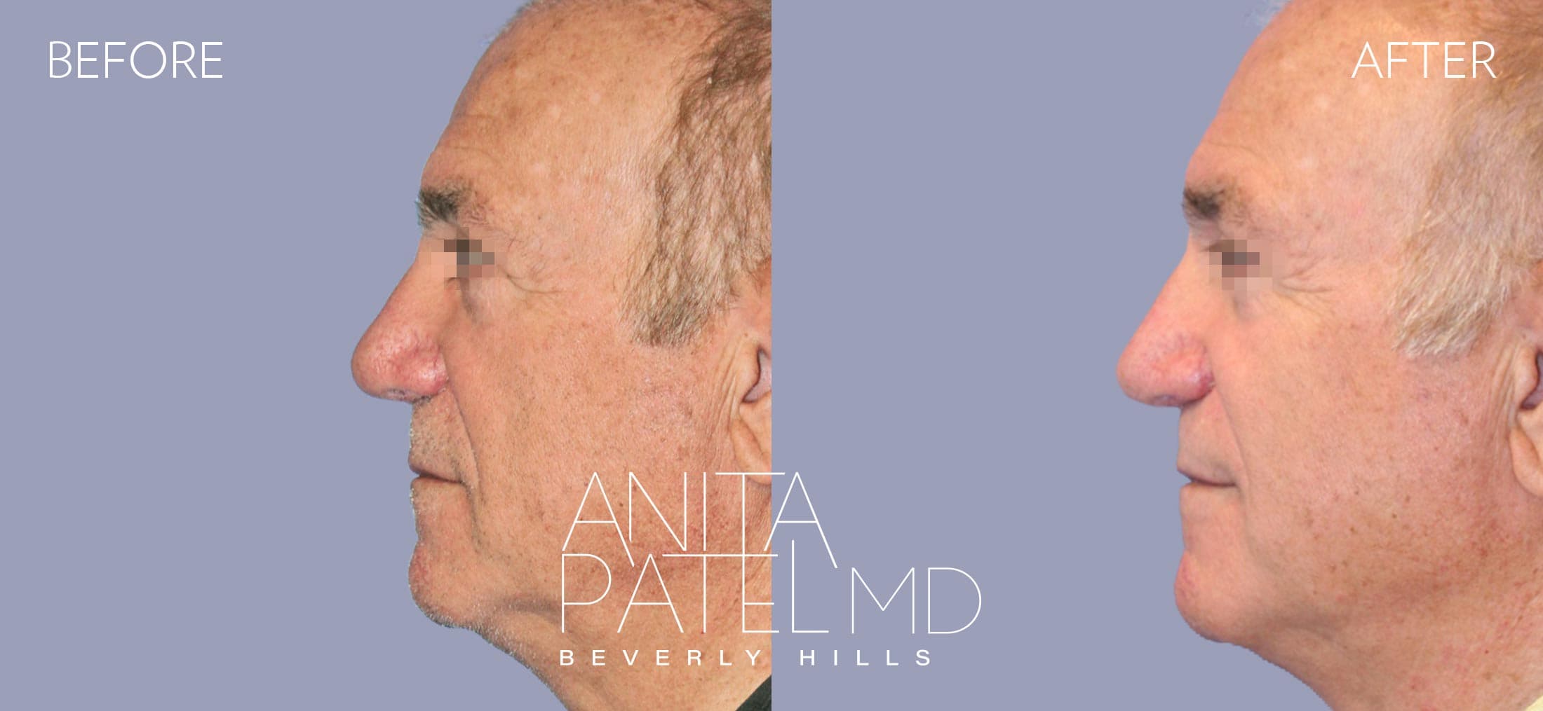 Rhinoplasty before and after — Patient 4 — Dr. Anita Patel, MD, FACS, Beverly Hills