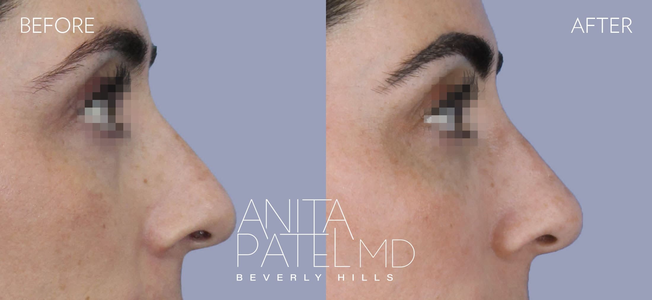 Liquid Rhinoplasty before and after — Patient 7, photo 1 of 2 — Dr. Anita Patel, MD, FACS, Beverly Hills