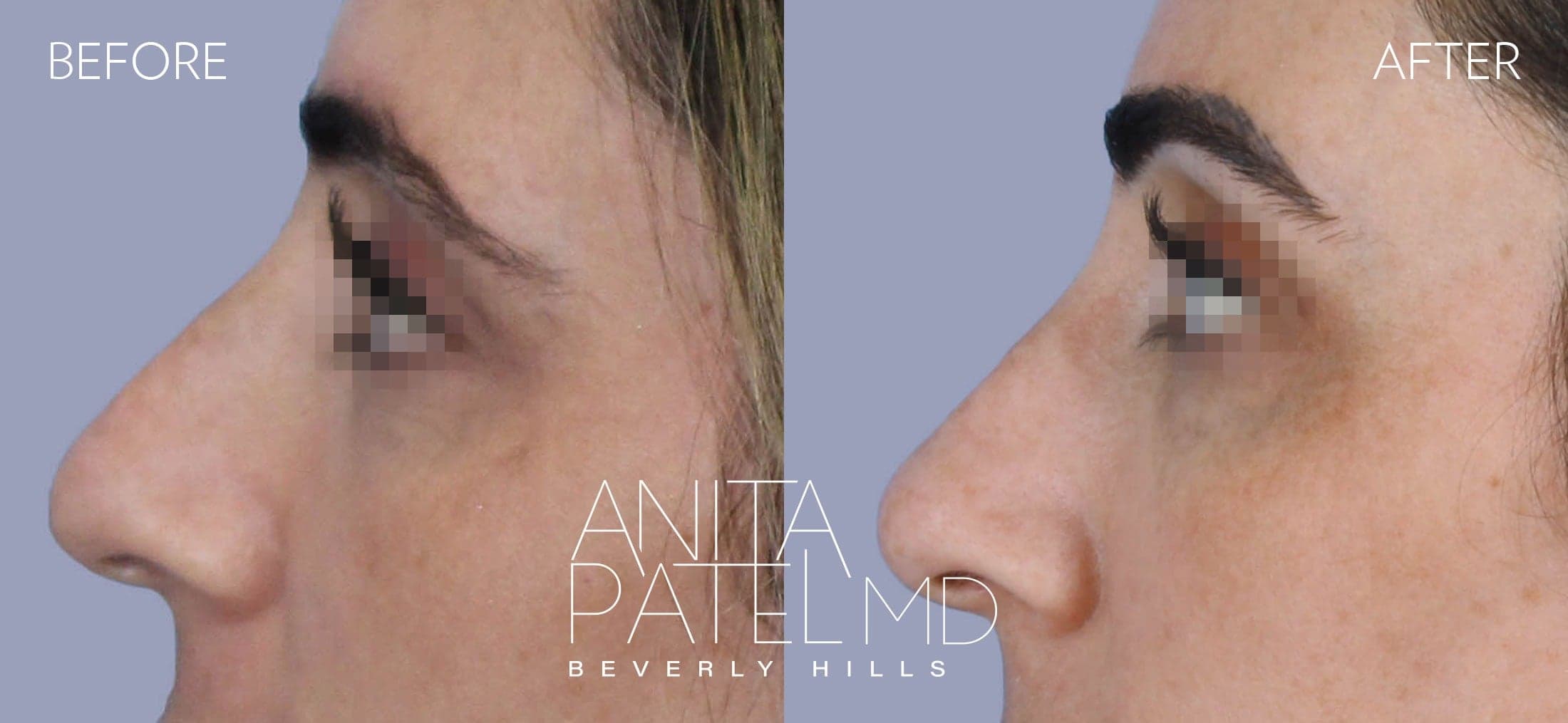 Liquid Rhinoplasty before and after — Patient 7, photo 2 of 2 — Dr. Anita Patel, MD, FACS, Beverly Hills