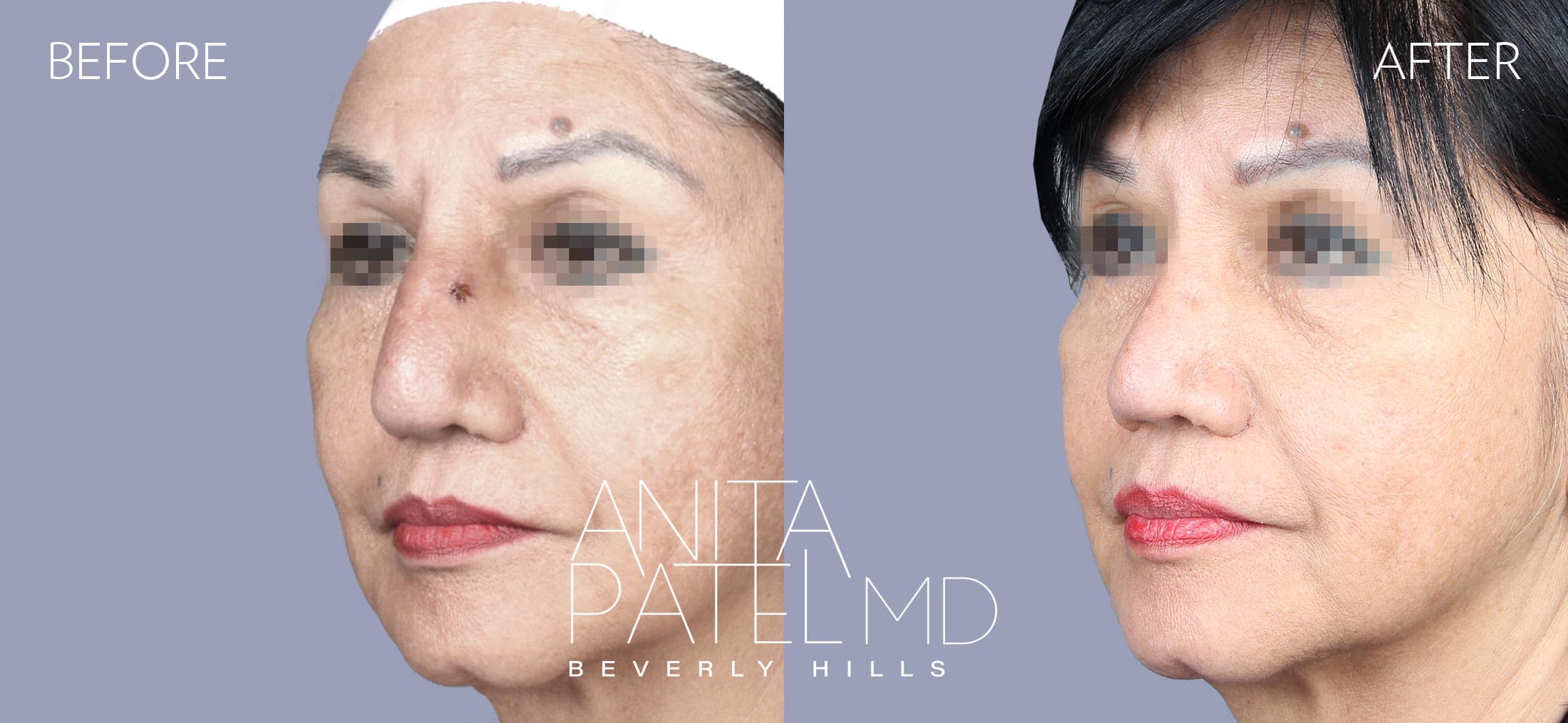 Rhinoplasty before and after — Patient 8 — Dr. Anita Patel, MD, FACS, Beverly Hills